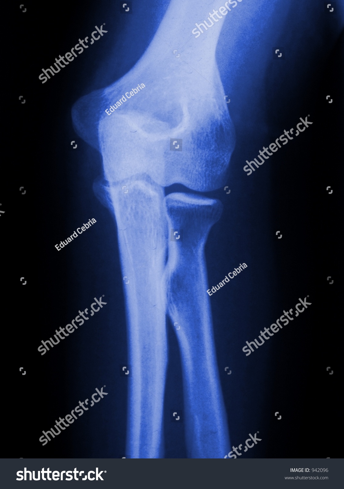 elbow xray photo ez canvas elbow xray