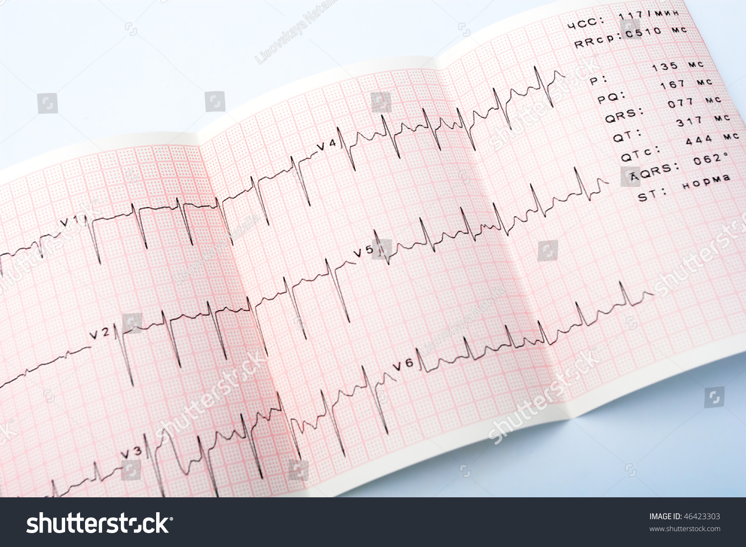 test ekg heart Stock Waveform Patients Showing Test Ekg Electrocardiogram