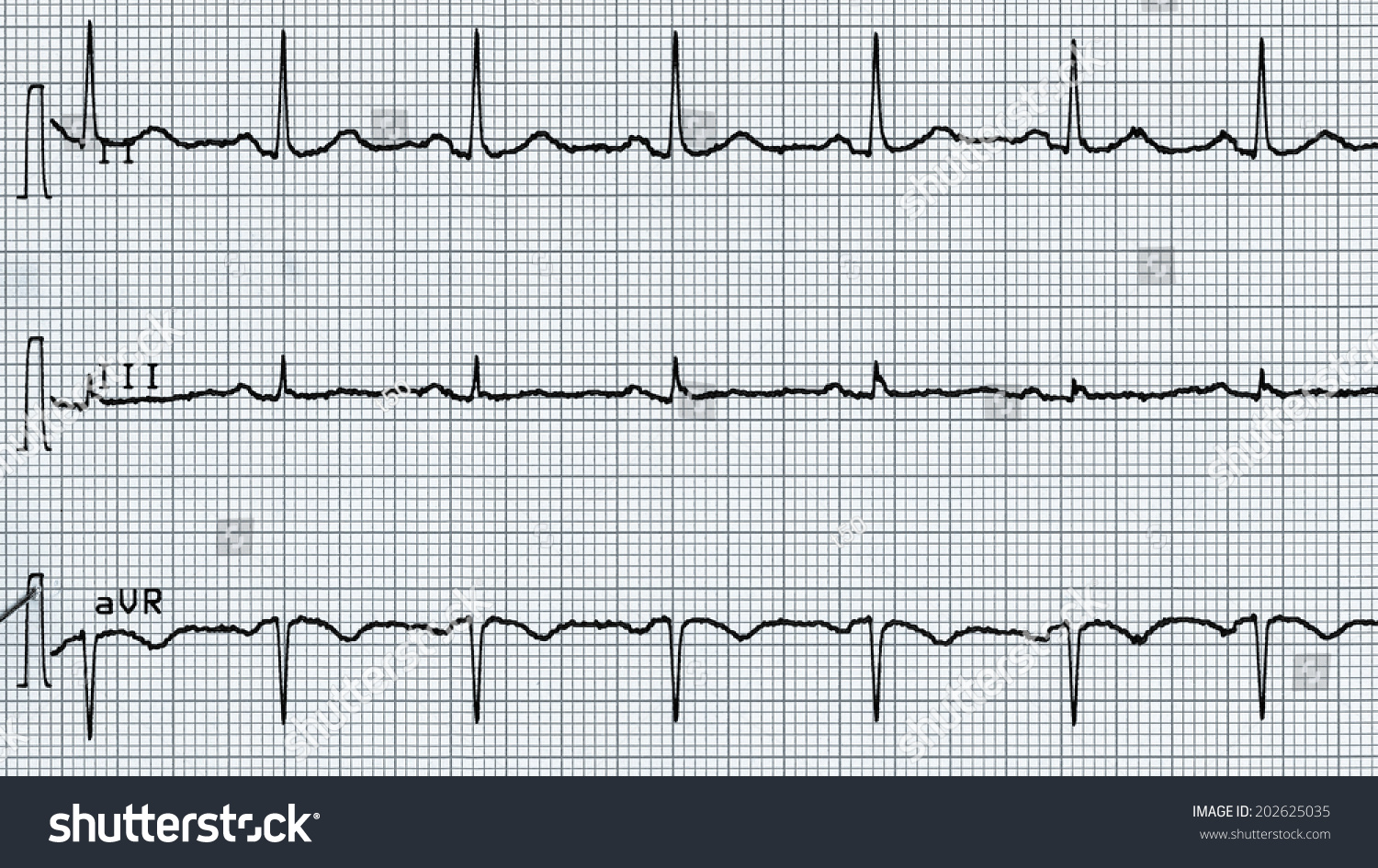 Electrocardiography Aka Ekg Elektrokardiogramm Measure Heartbeat Stock ...