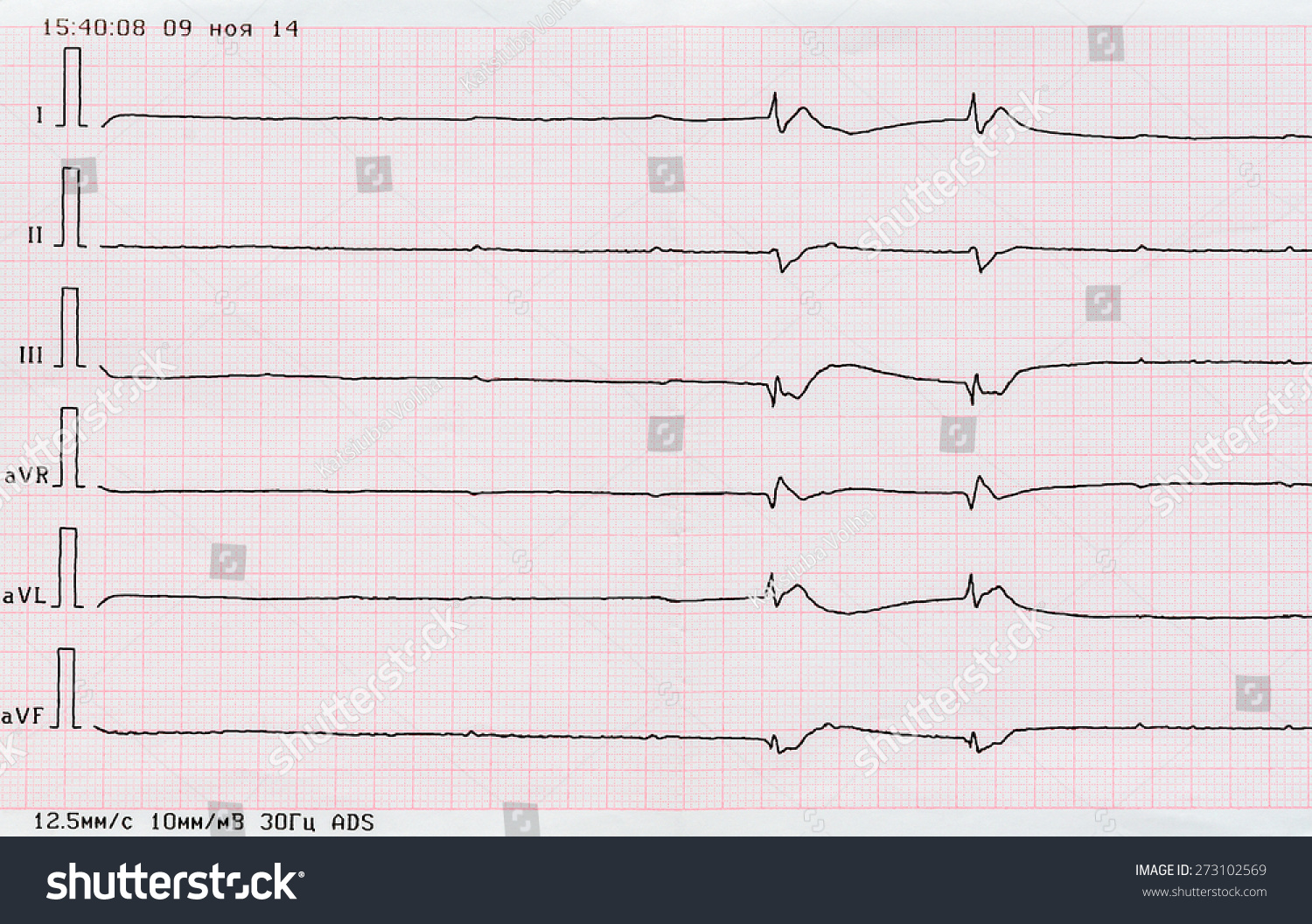 Emergency Cardiology Ecg Tape Single Ventricular Stock Photo (Edit Now ...