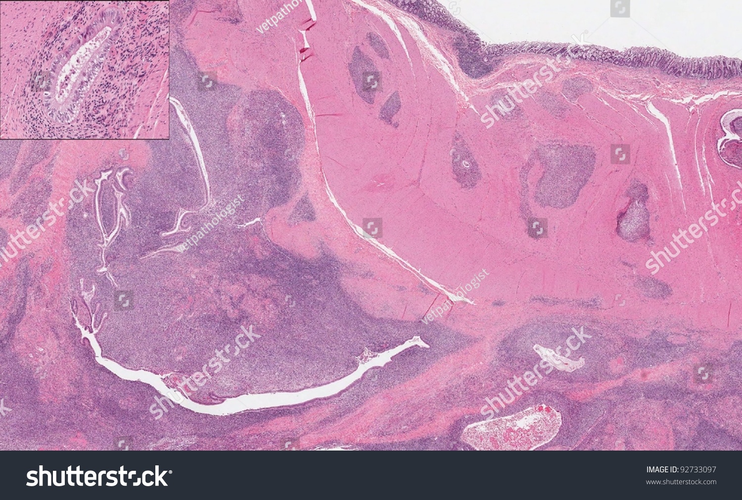 Endometriosis - Image Illustrates Uterine Endometrium Infiltrating The ...