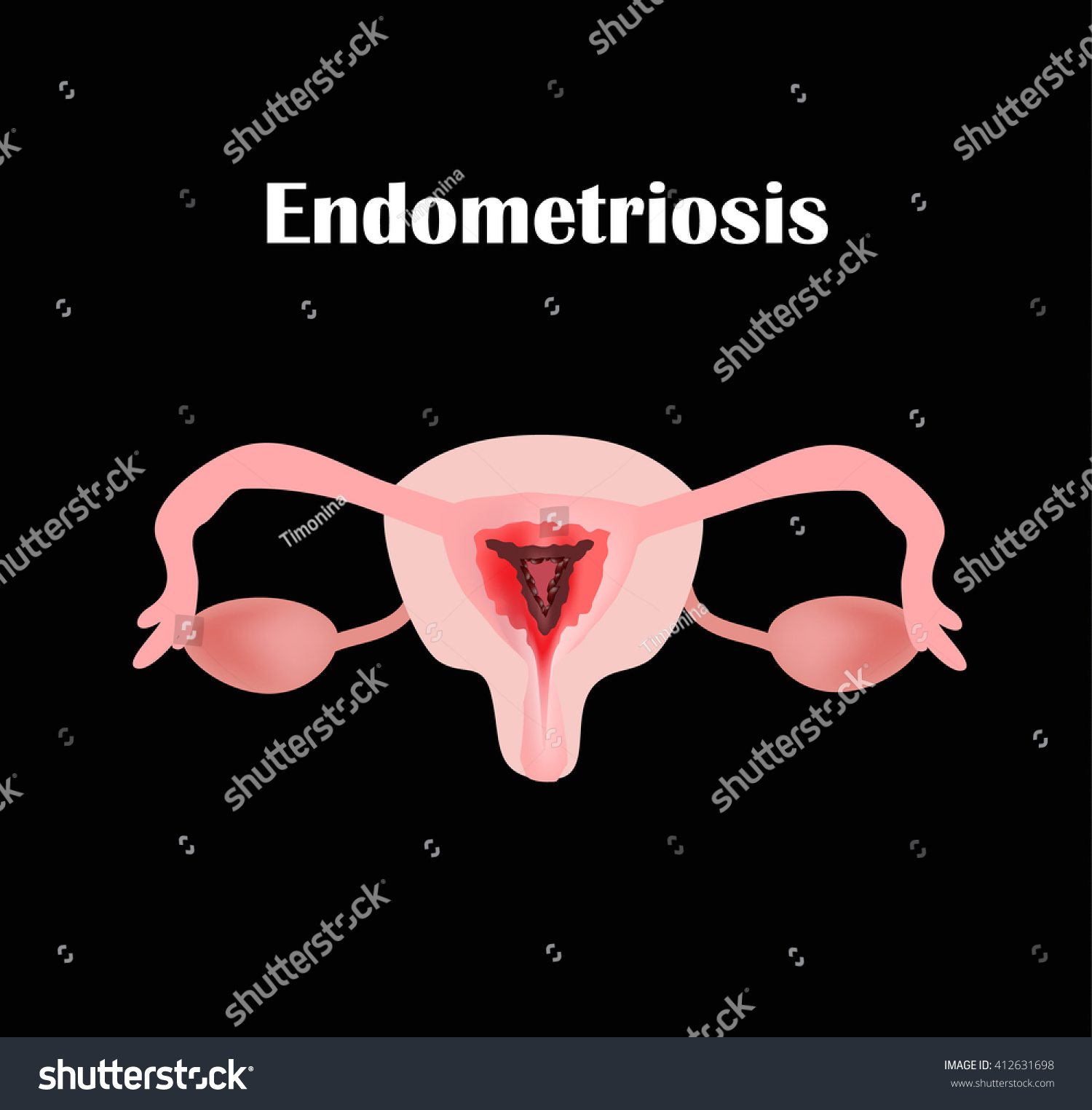 Endometriosis Structure Pelvic Organs Adenomyosis Endometrium стоковая иллюстрация 412631698 4121