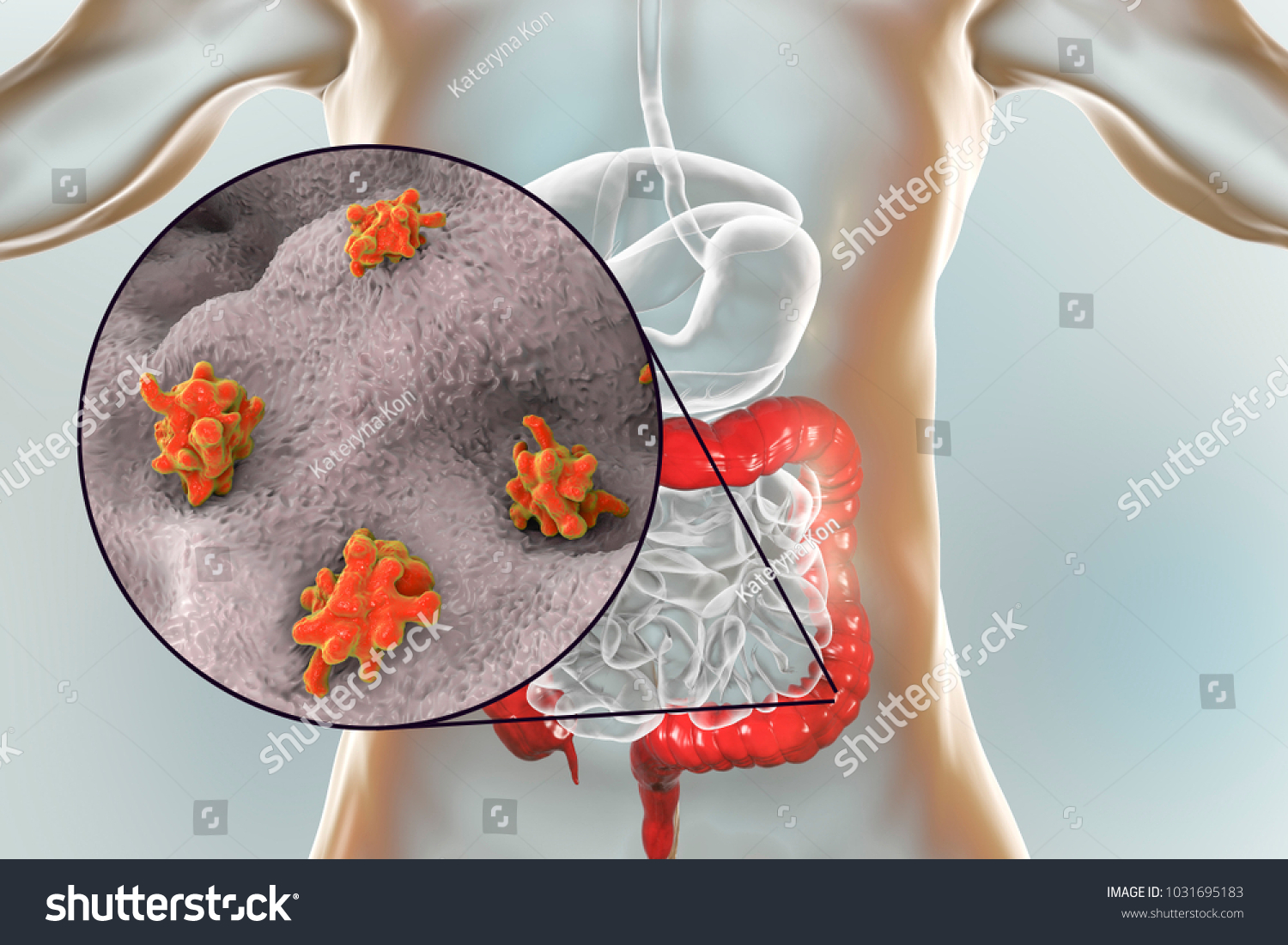 Entamoeba Histolytica Protozoan Infection Large Intestine Stock Illustration 1031695183 8317