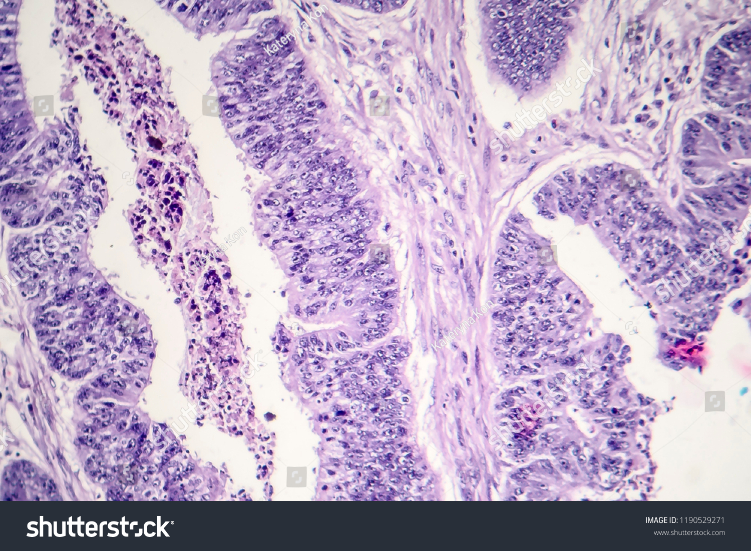 Esophageal Squamous Cell Carcinoma Light Micrograph Stock Photo (edit 