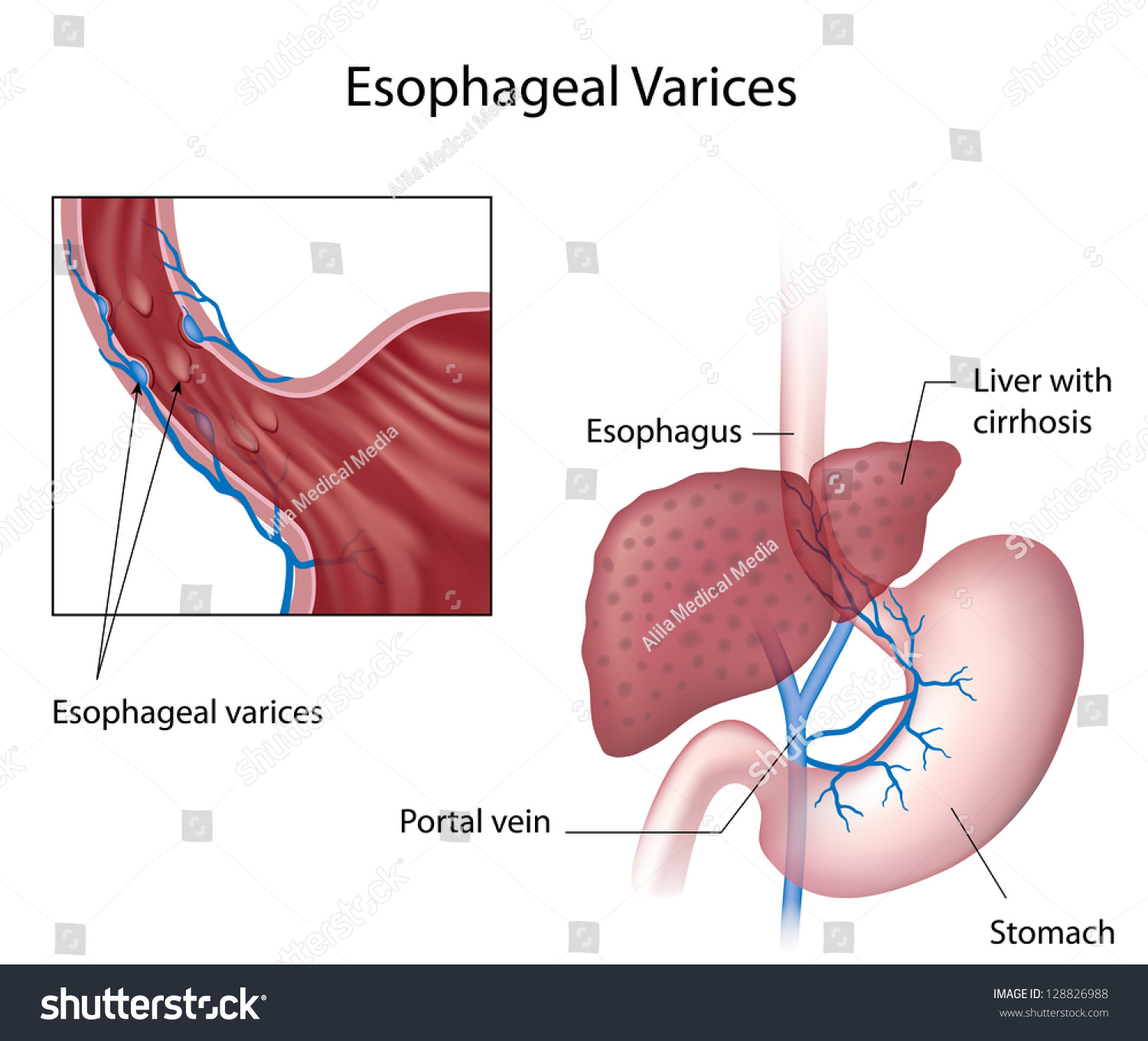 Varices: what to do 14 Varices: what to do 15
