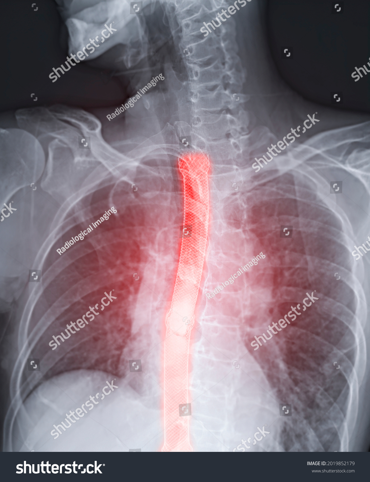 358 Esophageal surgery Images, Stock Photos & Vectors | Shutterstock