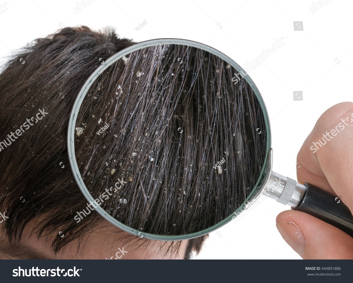 Examiming White Dandruff Flakes Hair Magnifying Stock Photo Edit Now 444891886