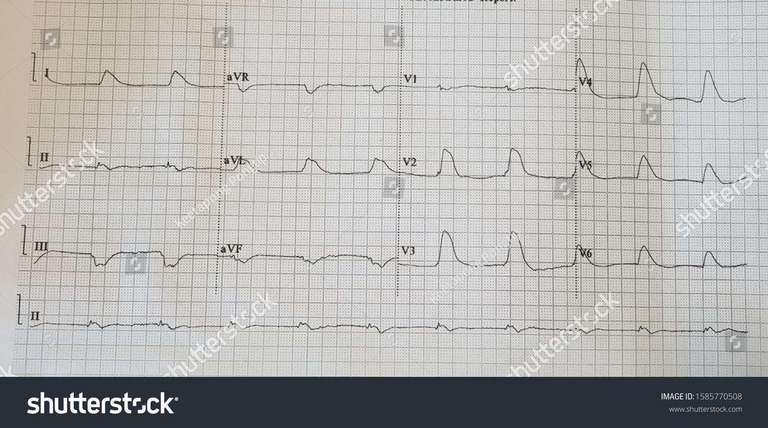 Extensive Anterior Wall St Elevation Myocardial Stock Photo (Edit Now ...