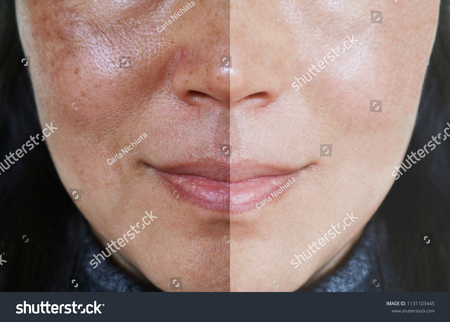 3,265 Melasma skin Images, Stock Photos & Vectors | Shutterstock
