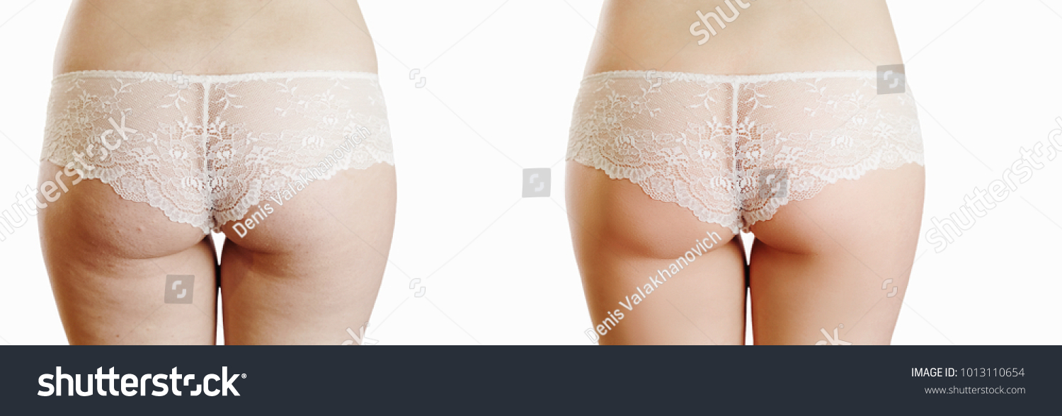 Female Buttocks Cellulite Before After On 스톡 사진 1013110654 Shutterstock 8209