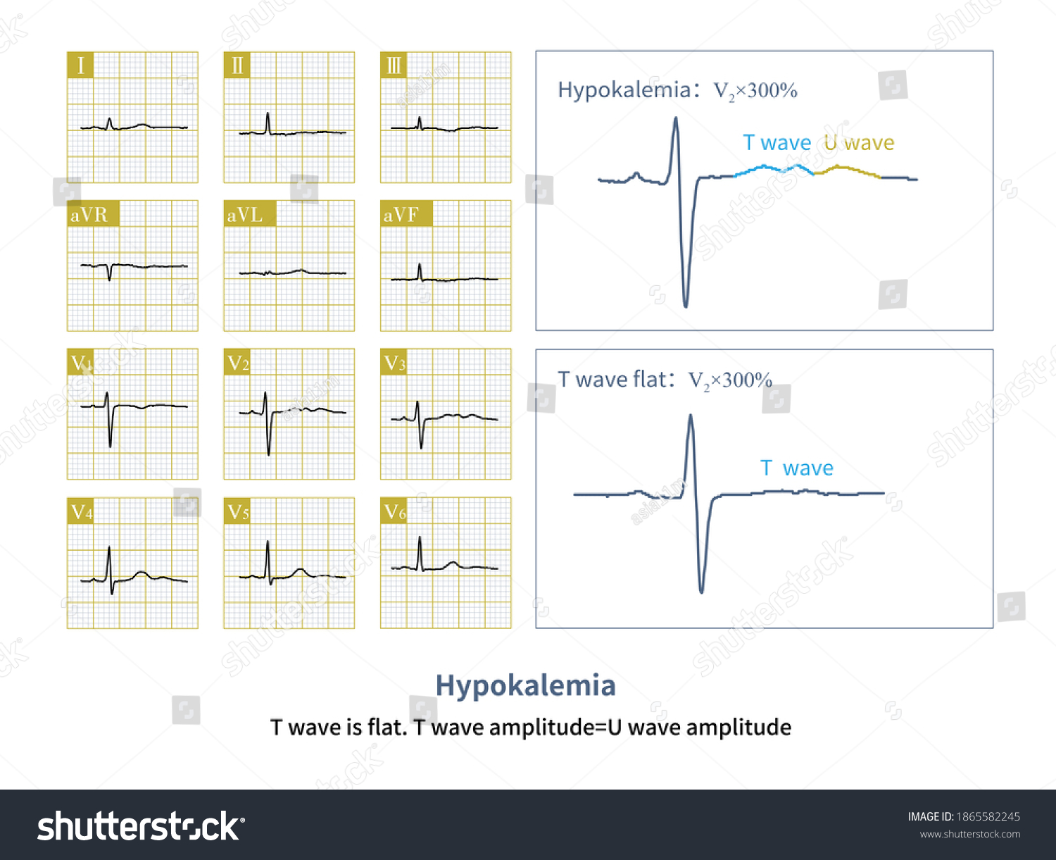 Hypokalemia Images, Stock Photos & Vectors | Shutterstock