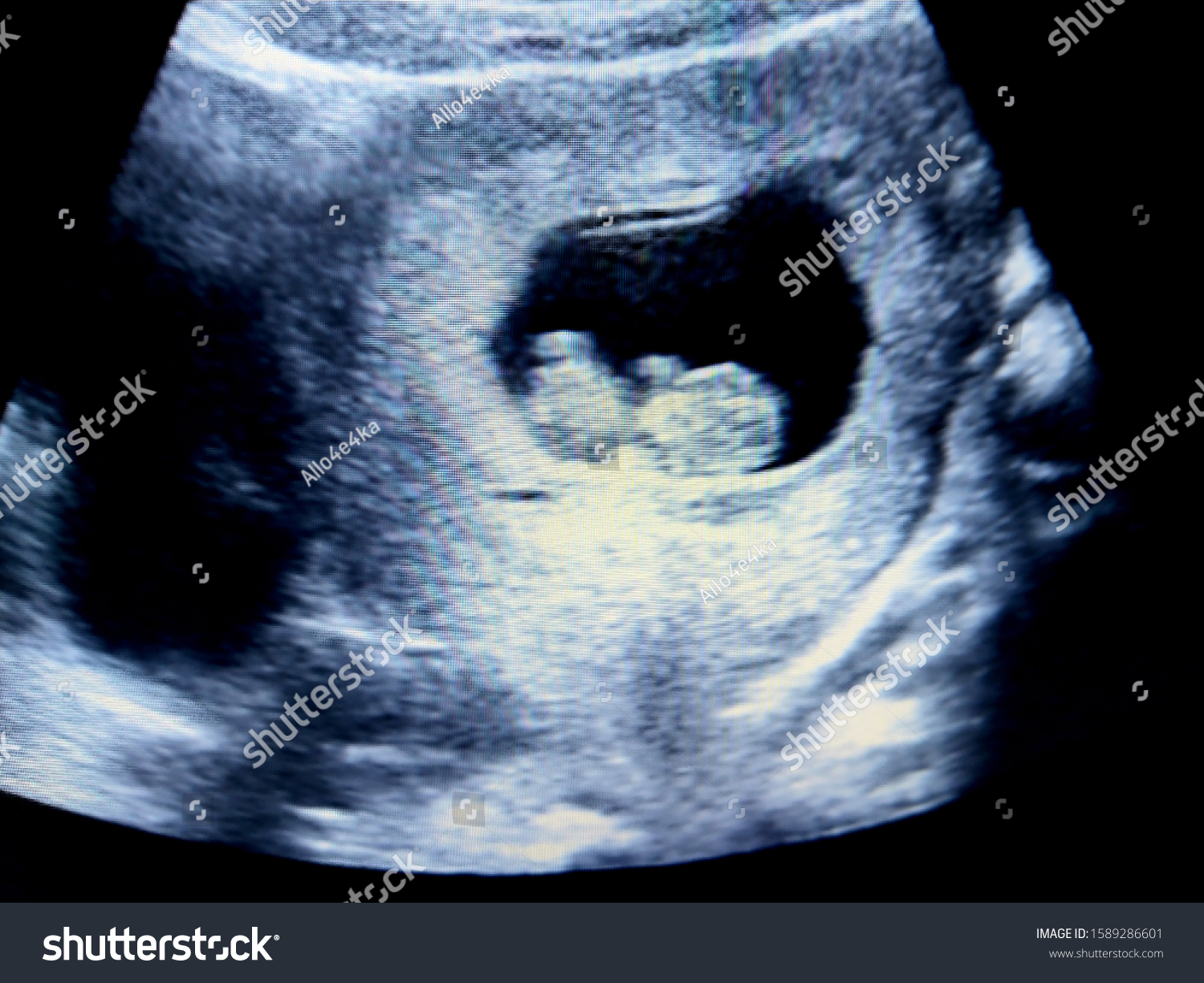 Fetus 10 Weeks By Ultrasound Scan Stock Photo 1589286601 | Shutterstock