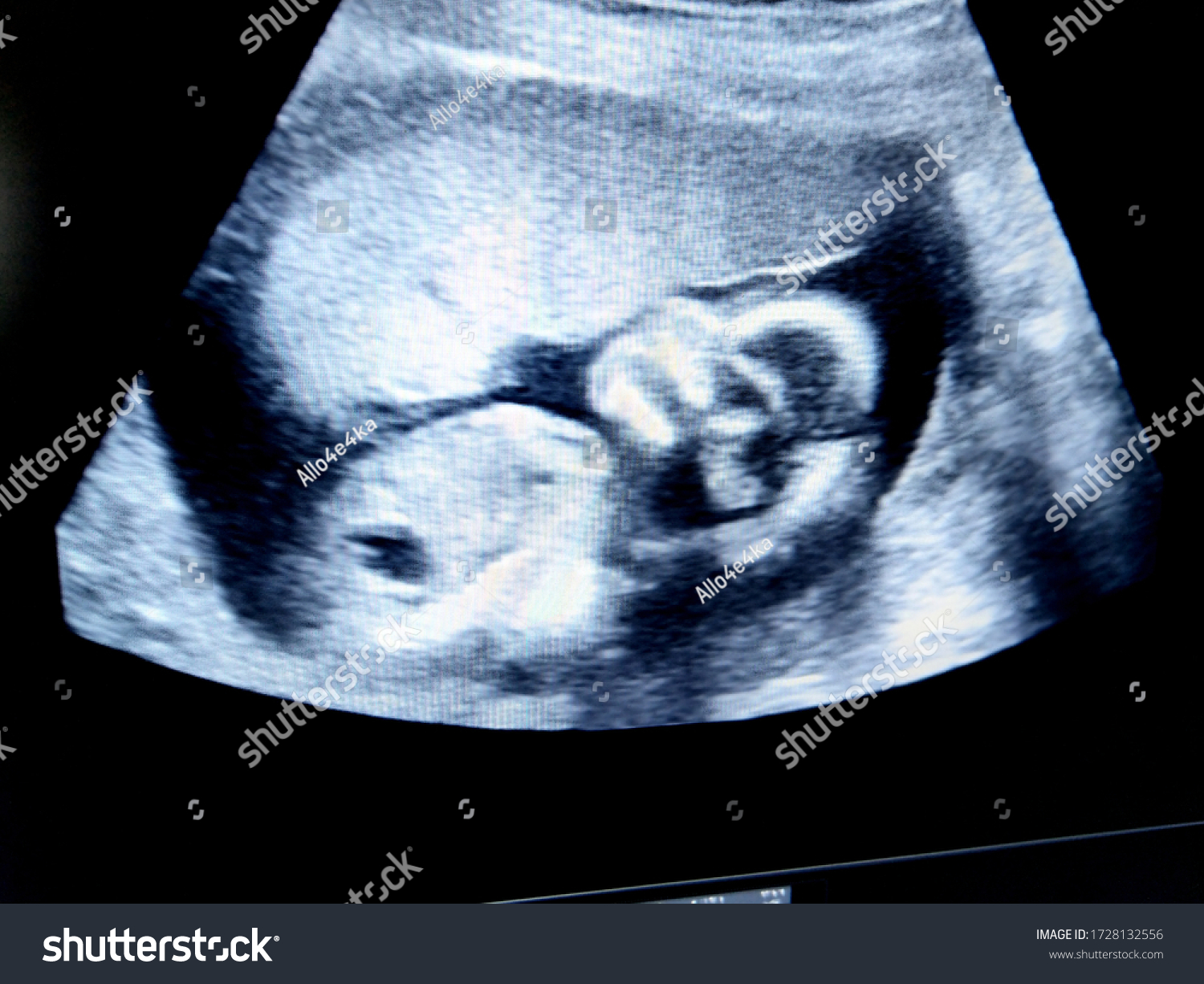 Fetus 24 Weeks By Ultrasound Scan Stock Photo Edit Now 1728132556   Stock Photo Fetus Weeks By Ultrasound Scan 1728132556 