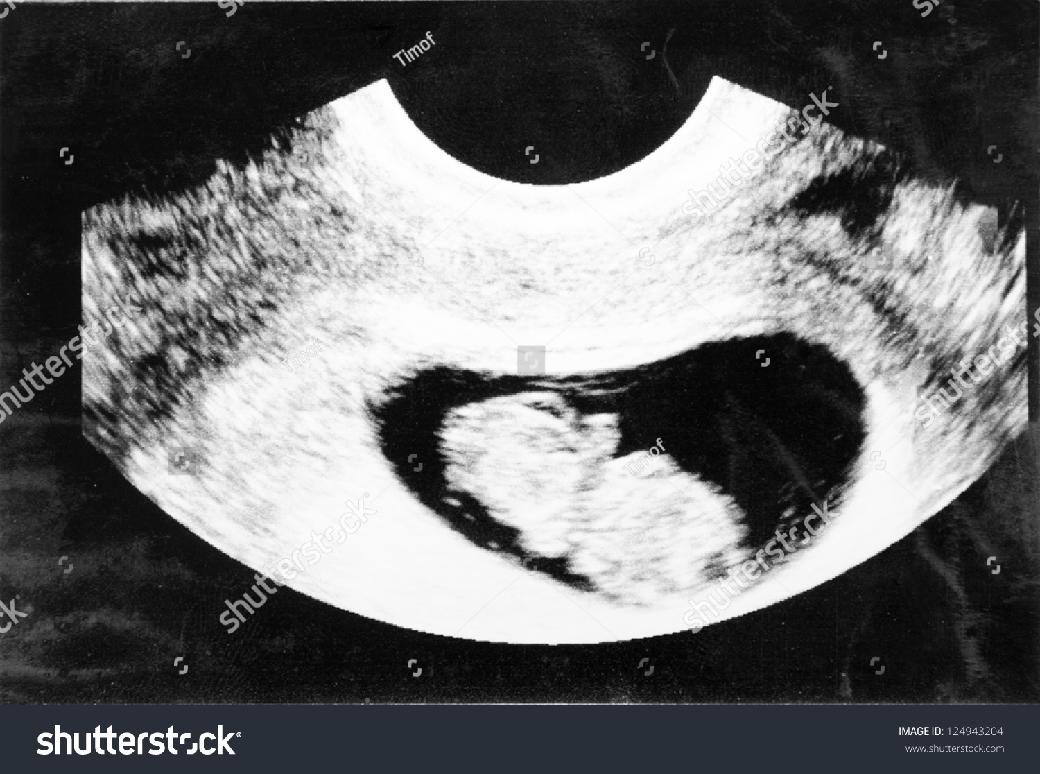 Fetus 9 Weeks Womb Stock Photo 124943204 - Shutterstock