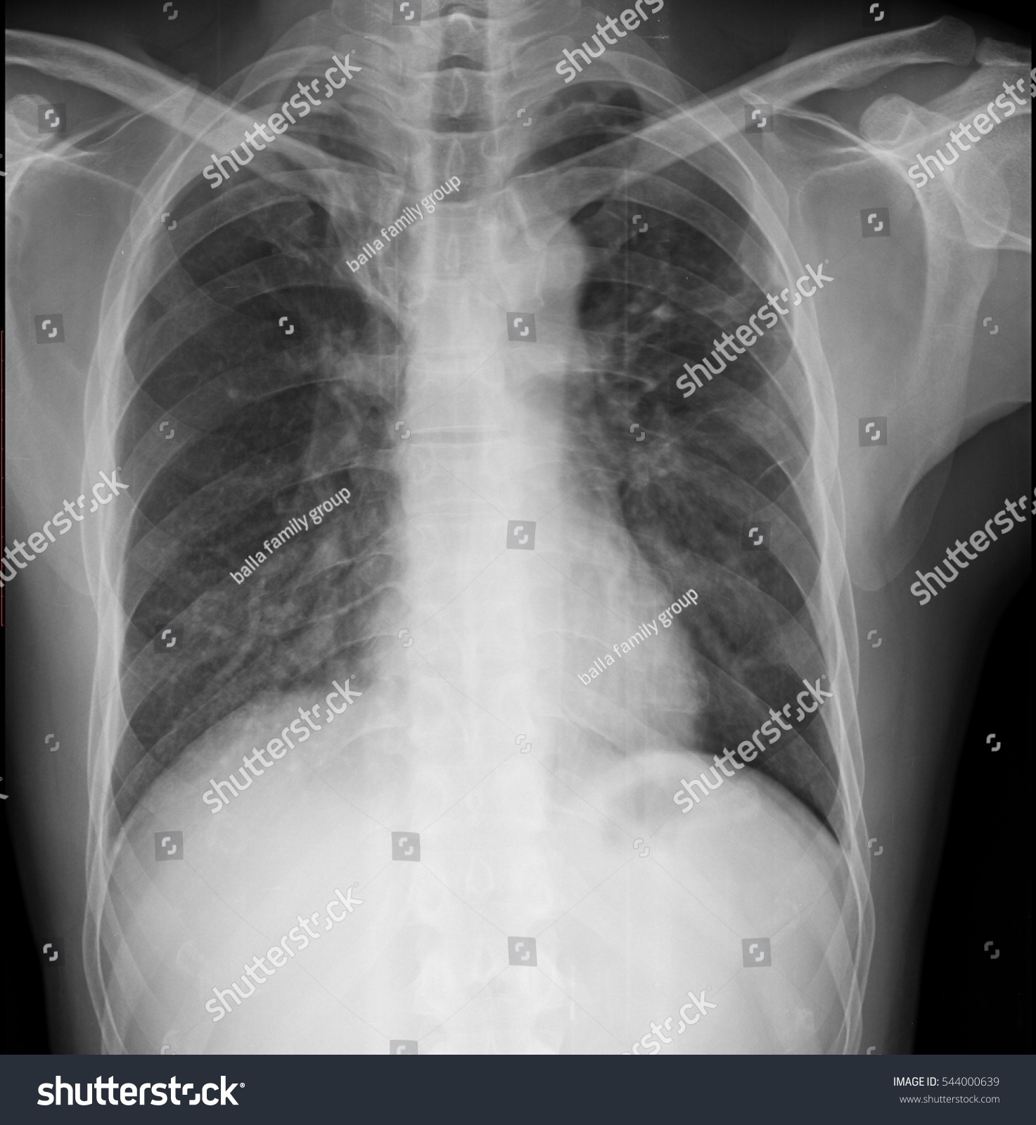 Fibrocafication Both Upper Lungs Pleural Thickening Stock Photo ...