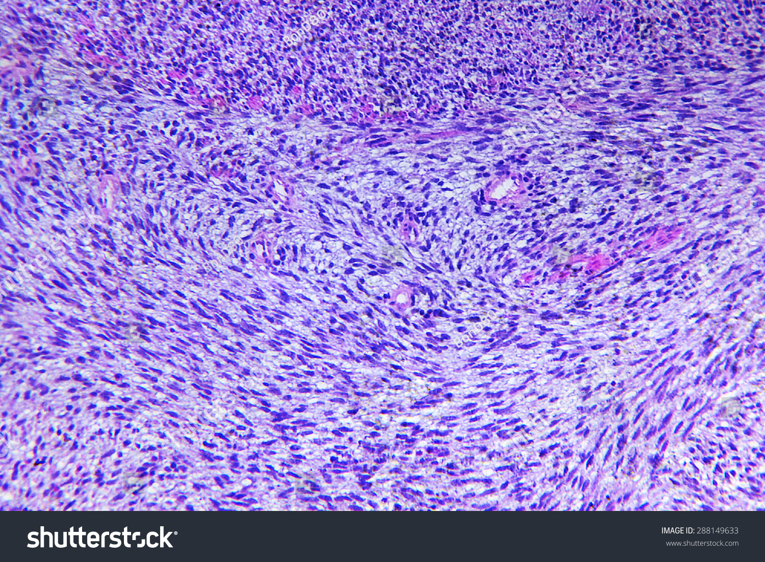 Fibrosarcoma Of A Human, Photomicrograph Panorama As Seen Under The ...