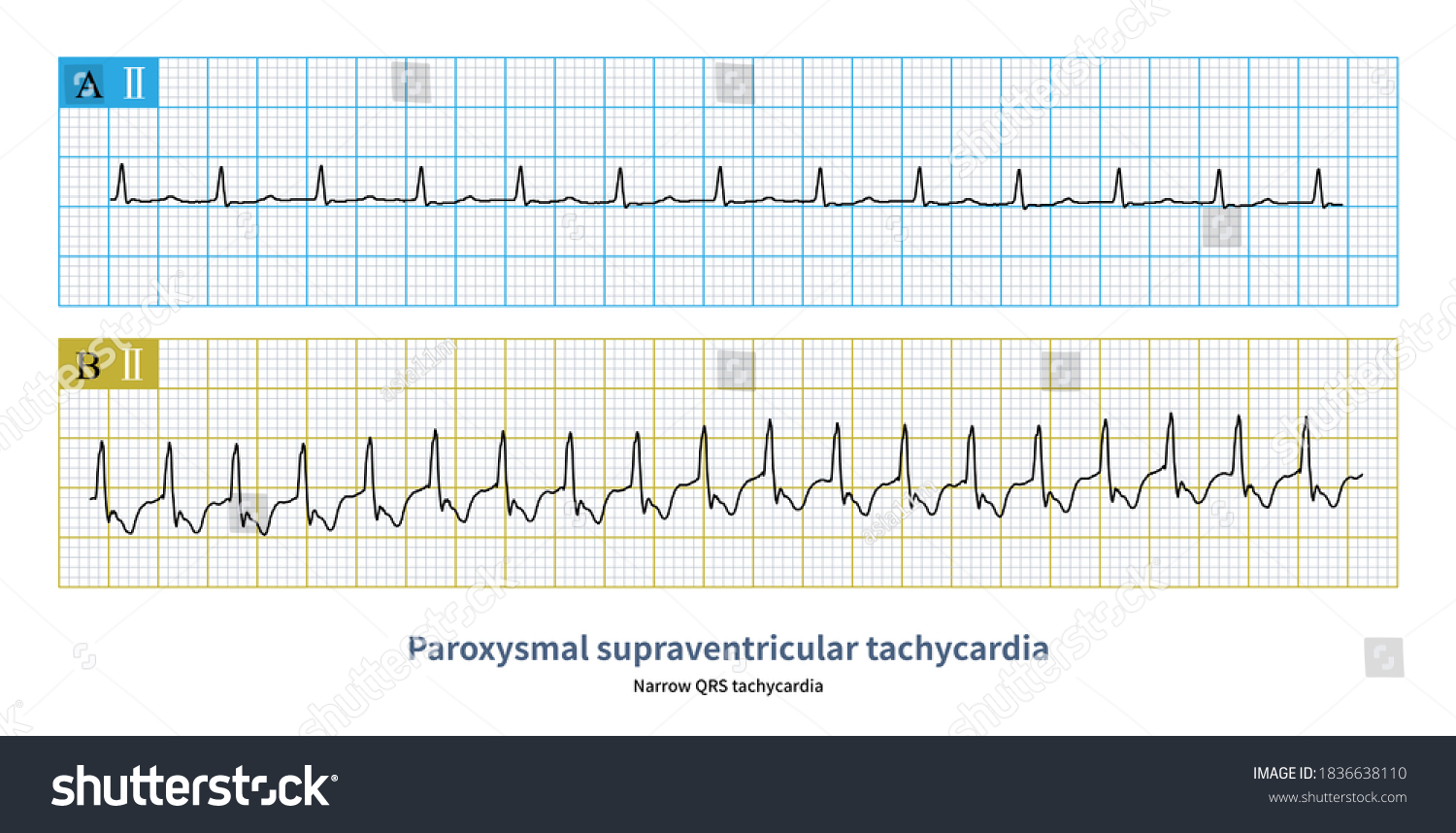 Figure Atrioventricular Nodal Reentrant Tachycardia Figure ...