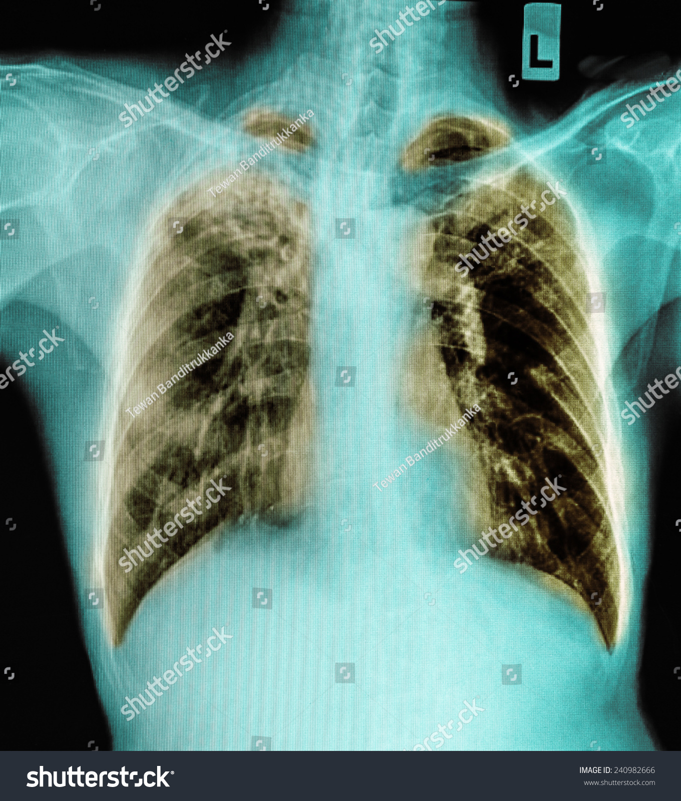 Film Chest Pneumonia Stock Photo 240982666 | Shutterstock