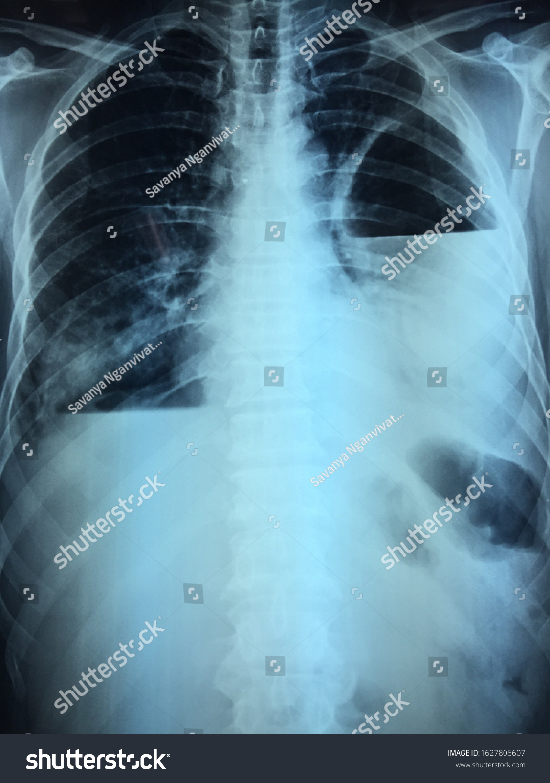 Film Chest Xray Lung Infection Stock Photo 1627806607 | Shutterstock