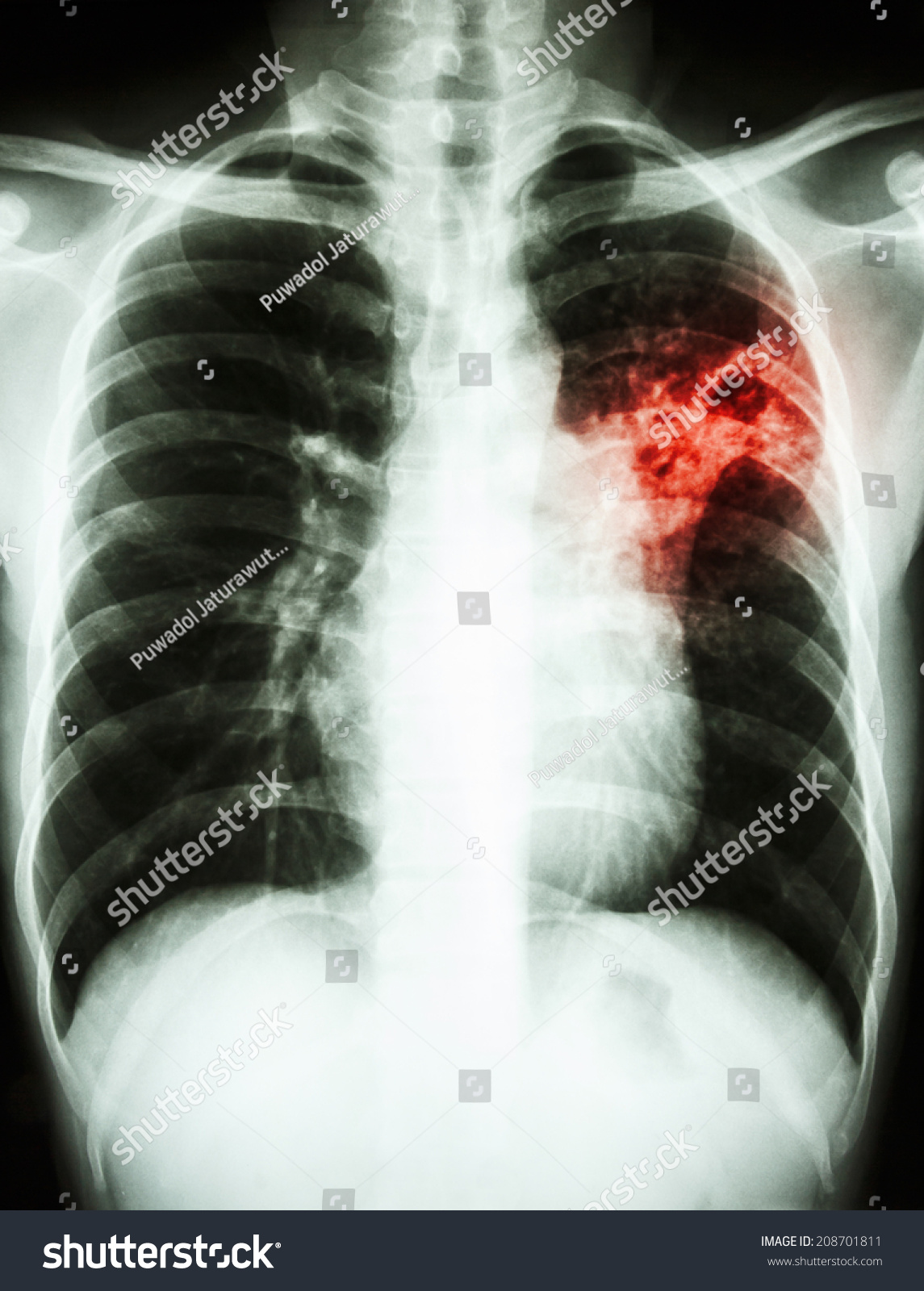 Film Chest Xray Show Alveolar Infiltrate Stock Photo 208701811 ...