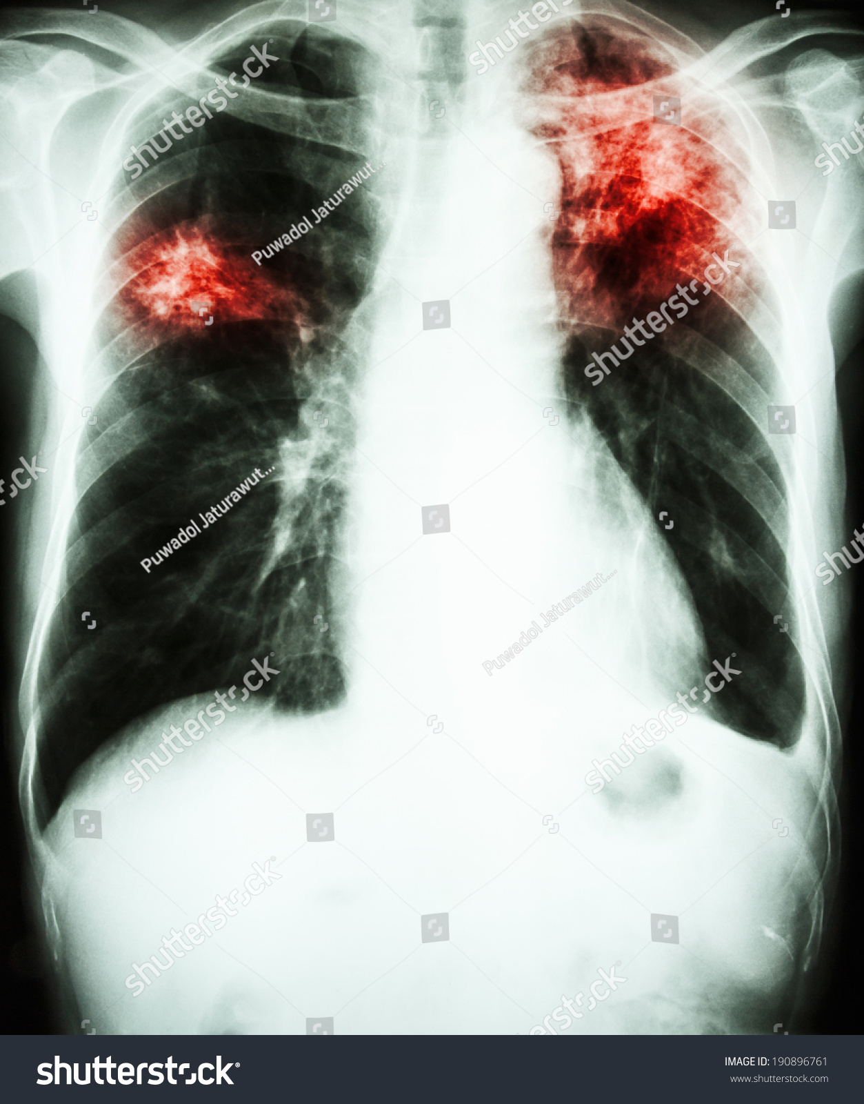 Film Chest Xray Show Alveolar Infiltrate Stock Photo 190896761 ...