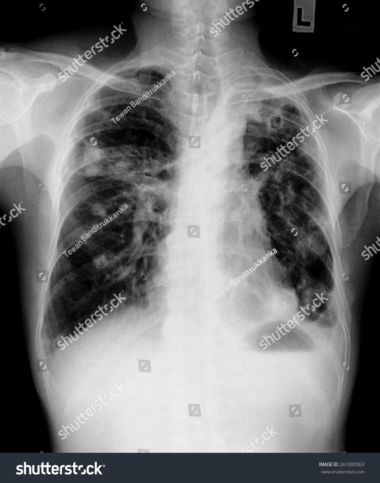 Film Chest Xray Show Alveolar Infiltrate Stock Photo 261000563 