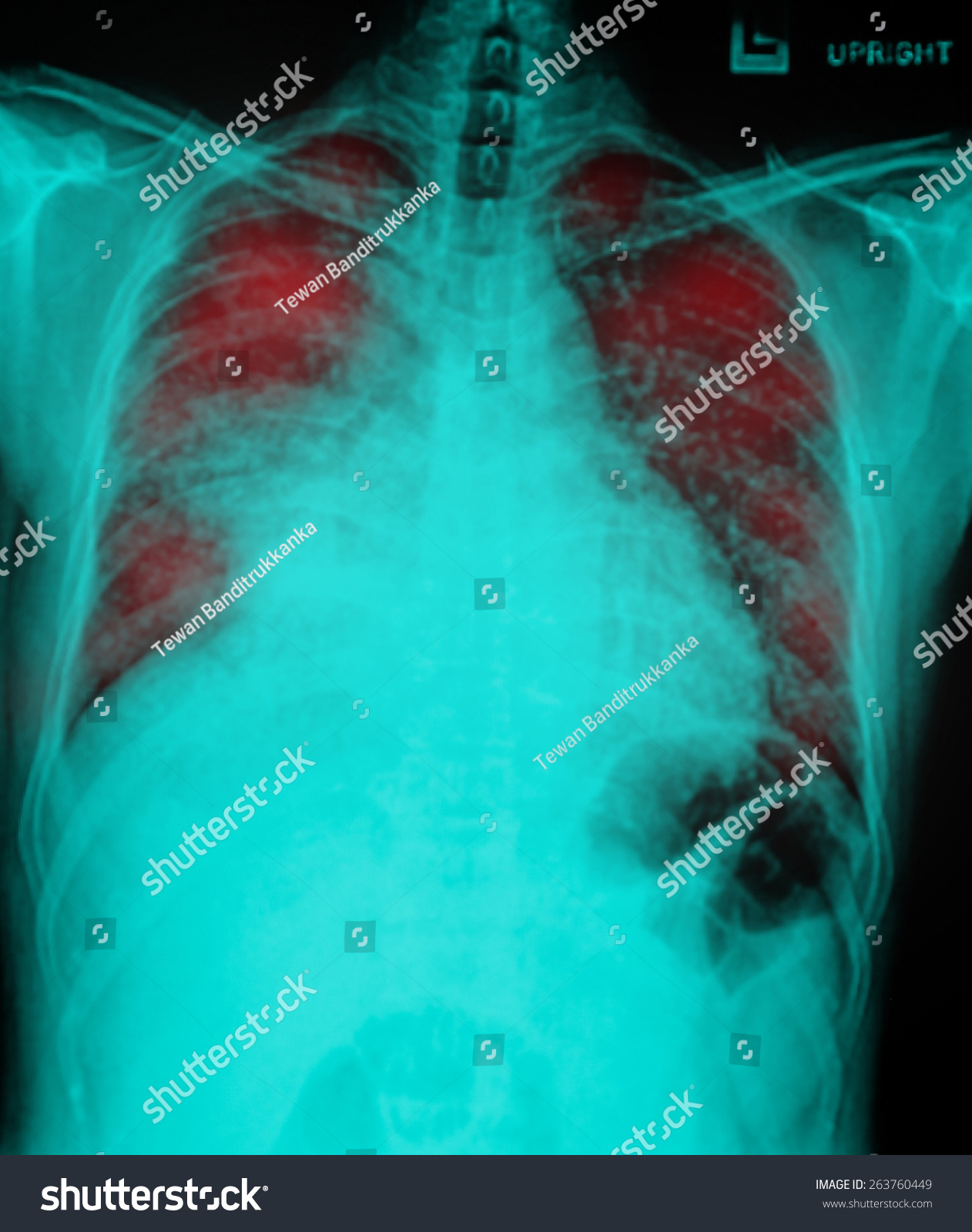 Film Chest Xray Show Alveolar Infiltrate Stock Photo (Edit Now) 263760449