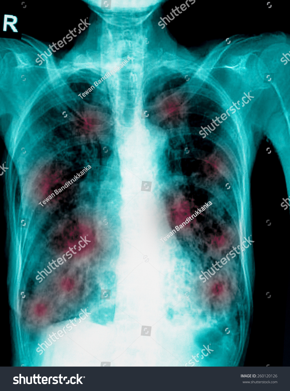 Film Chest Xray Show Cavity Right Stock Photo (Edit Now) 260120126