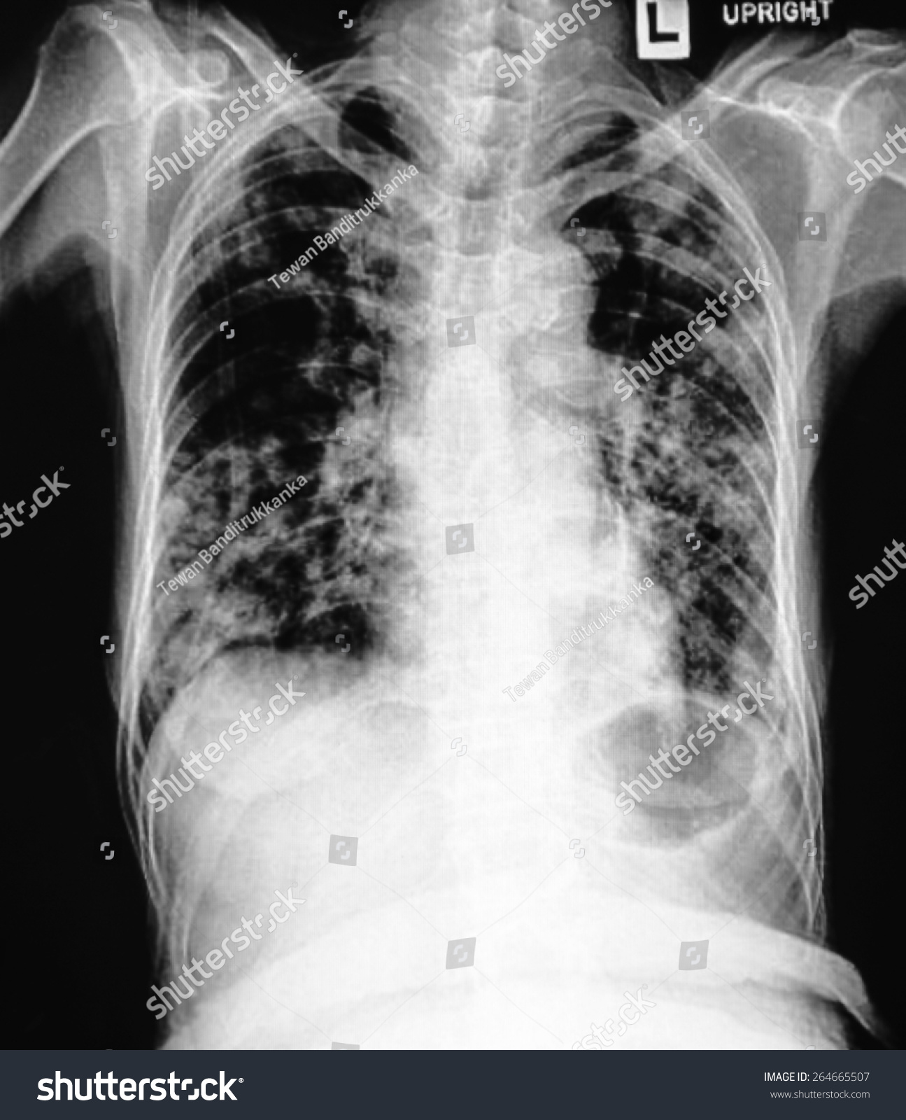 Film Chest Xray Show Cavity Right Stock Photo 264665507 - Shutterstock