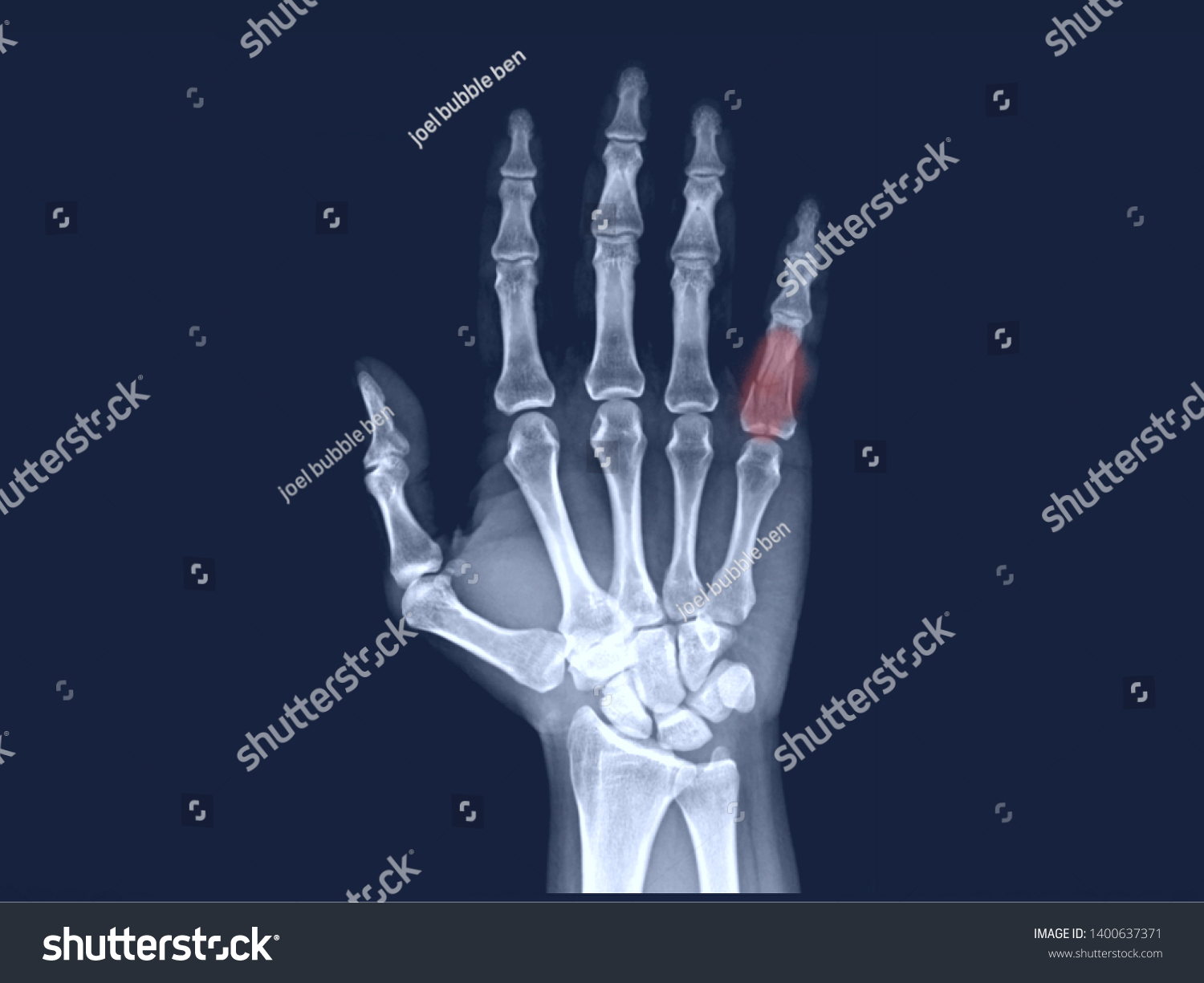 Film Hand Xray Radiograph Showing Finger Stock Photo 1400637371 ...