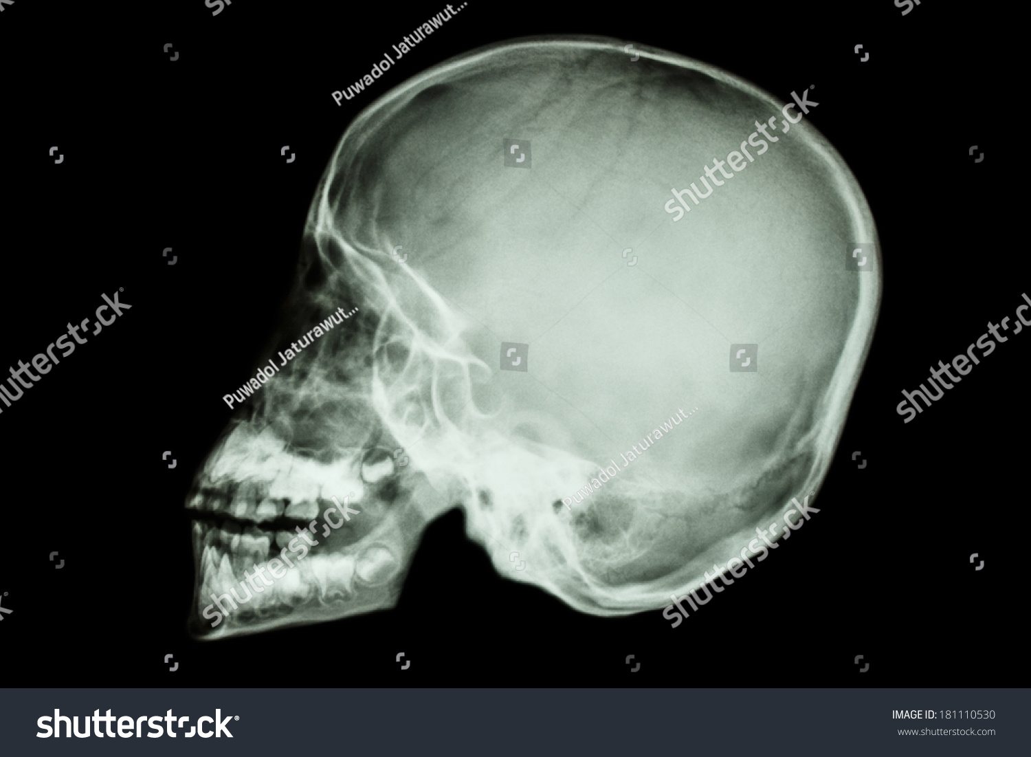 Film Xray Asian Childs Skull Thai Stock Photo (Edit Now) 181110530