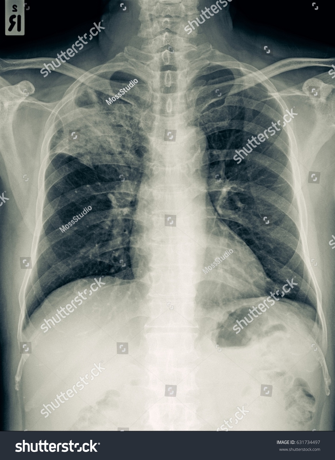 Film Xray Chest Cxr Pa View 庫存照片 立刻編輯 631734497