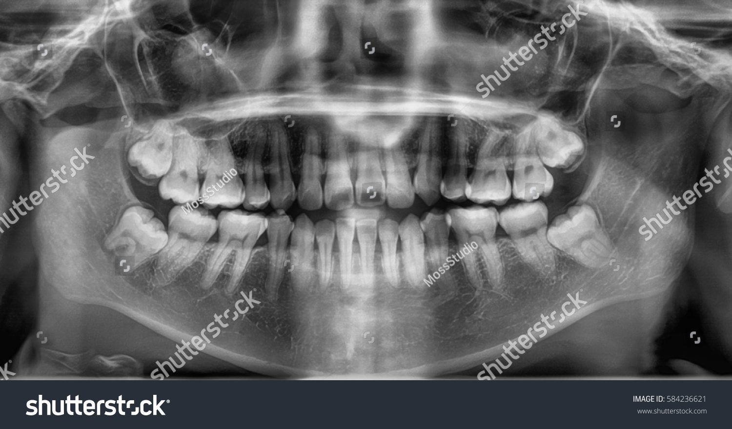 Film Xray Dental Panoramic View Show Stock Photo 584236621 | Shutterstock