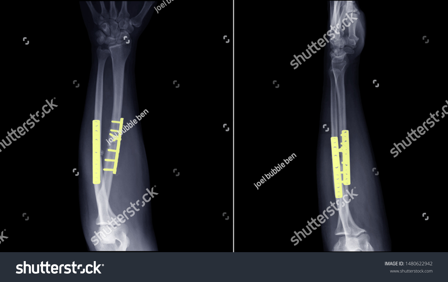 Film Xray Forearm Radiograph Show Forearm Stock Photo 1480622942