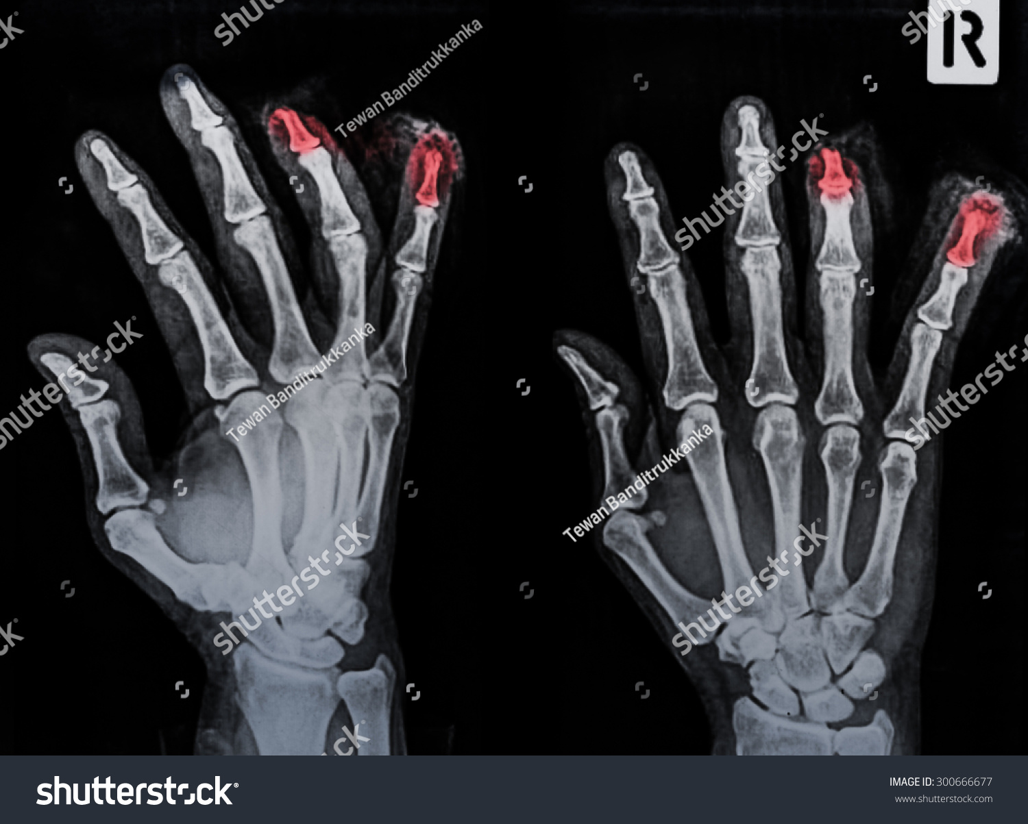 Film Xray Hand Ap Show Fracture Stock Photo 300666677 - Shutterstock