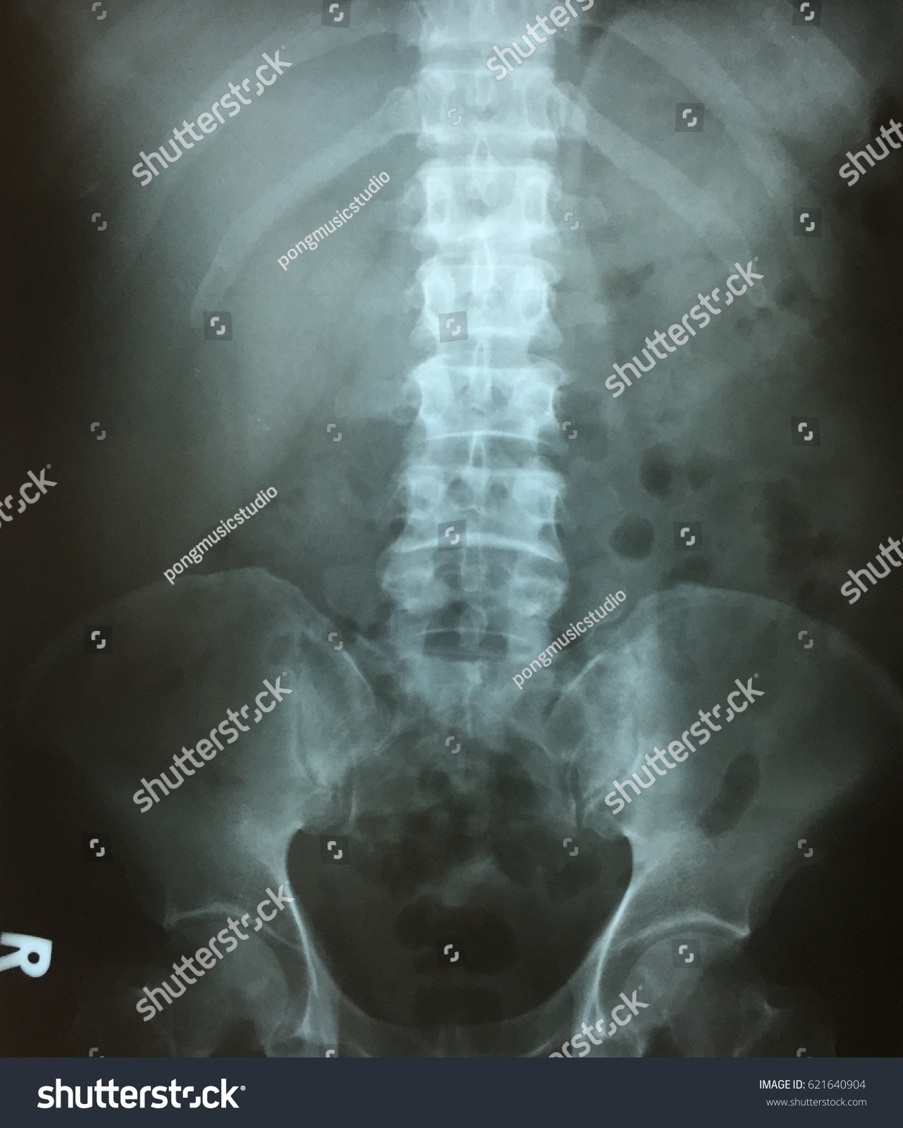 Film Xray KUB Demonstrated Normal Human Stock Photo (Edit Now