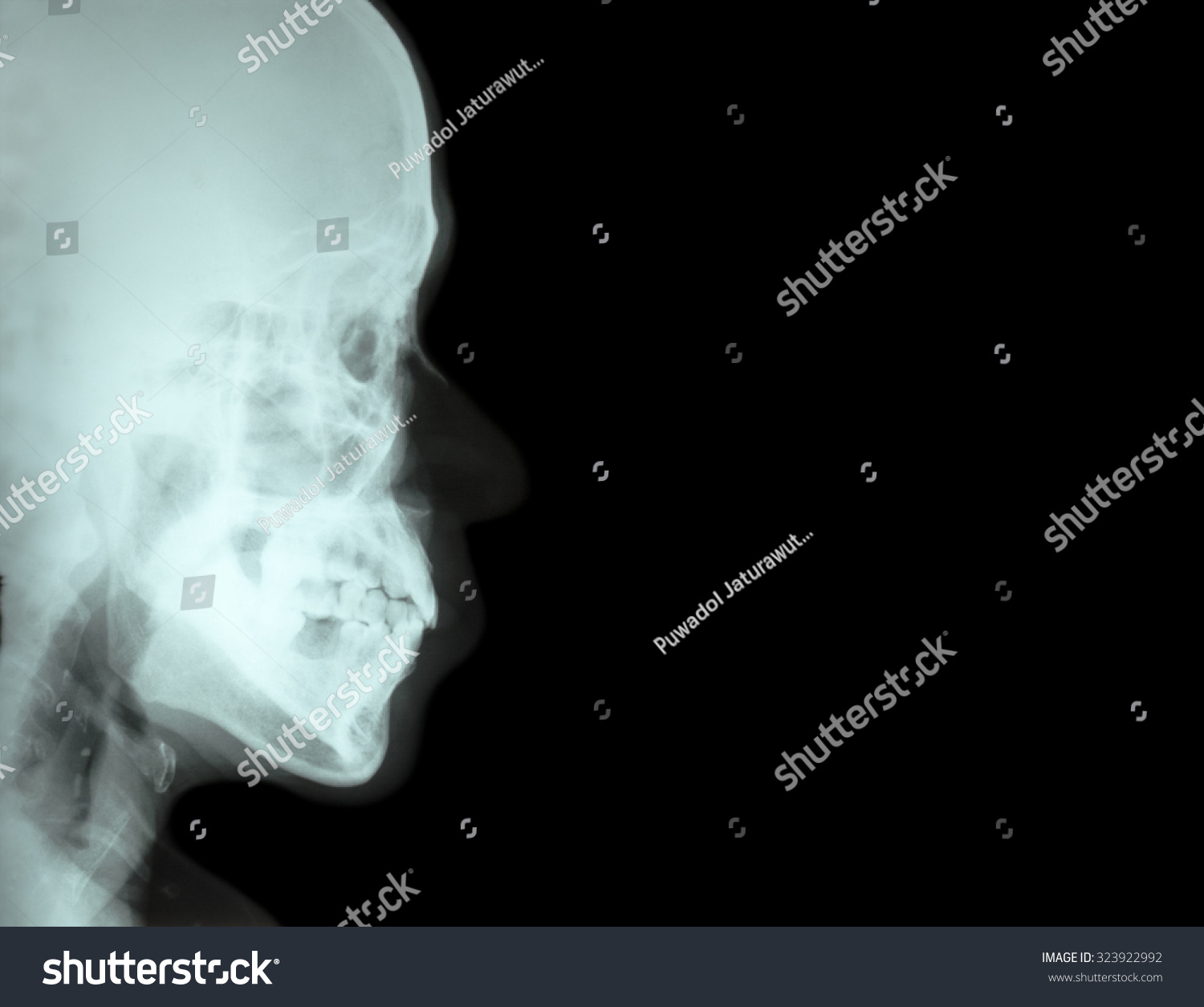 Film Xray Lateral Nasal Bone Side Stock Photo 323922992 | Shutterstock