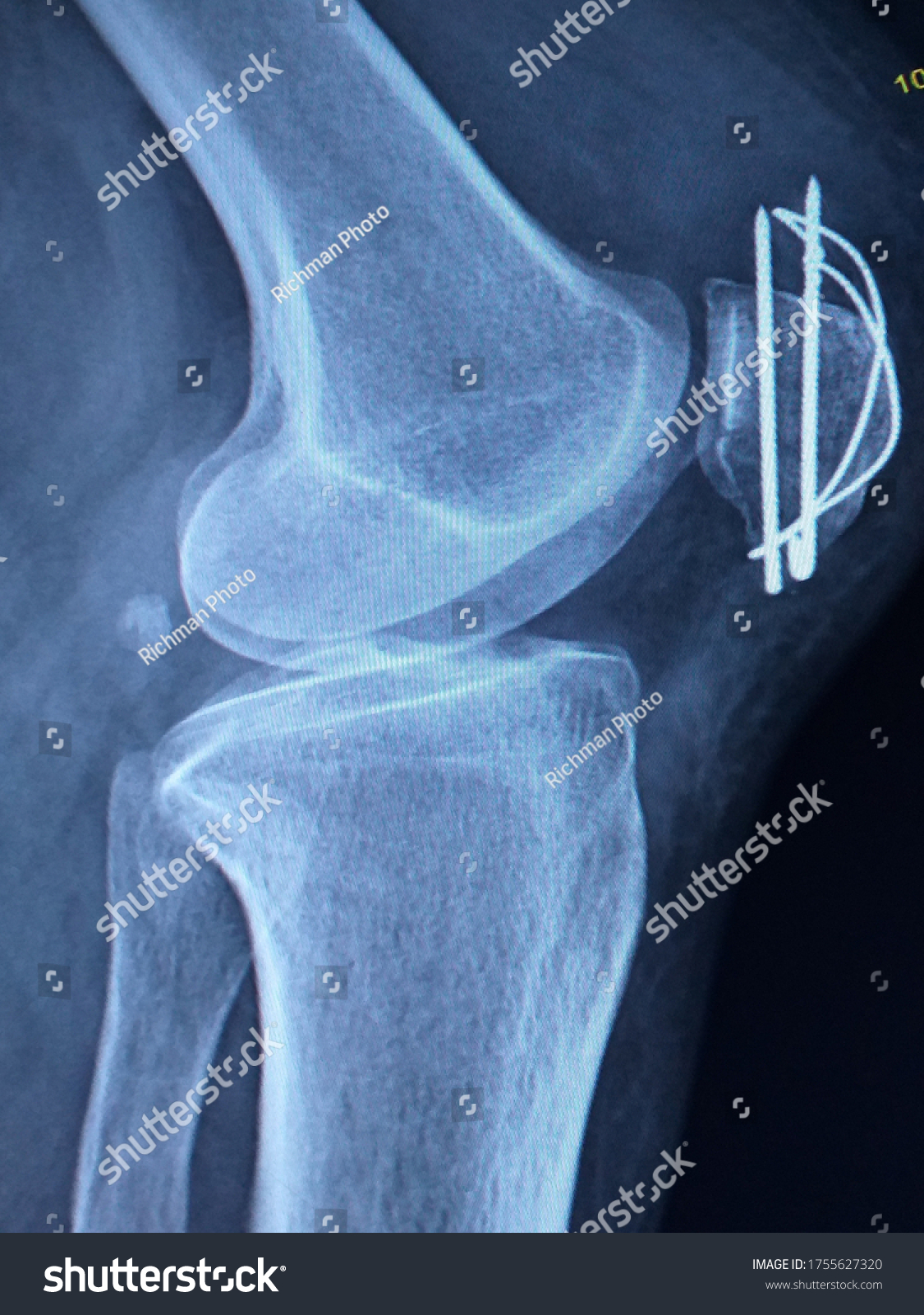 フィルムx線左膝前斜面骨折膝蓋骨折膝蓋骨 膝蓋骨 とk線と張線帯を持つorifの後置医療コンセプ の写真素材 今すぐ編集