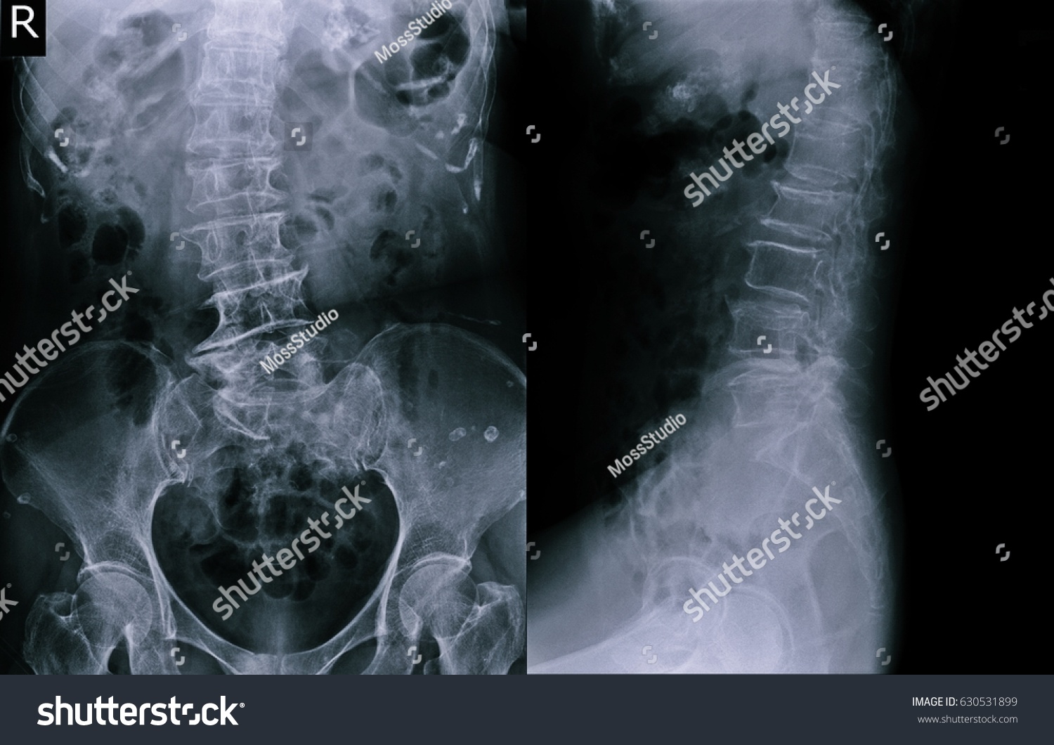 Film Xray Lumbar Spine Aplat ViewẢnh Có Sẵn630531899 Shutterstock 9019