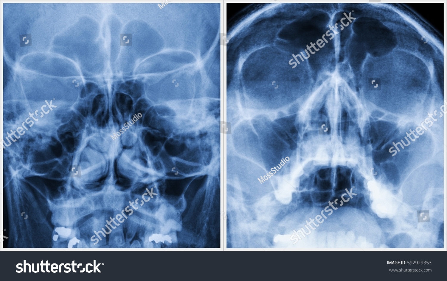 Film Xray Paranasal Sinuses Pns Caldwell Stock Photo Edit Now