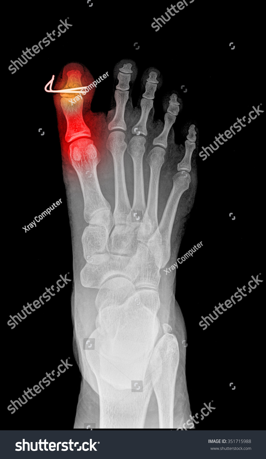 Film Xray Show Fracture Proximal Phalange Stock Photo 351715988 ...