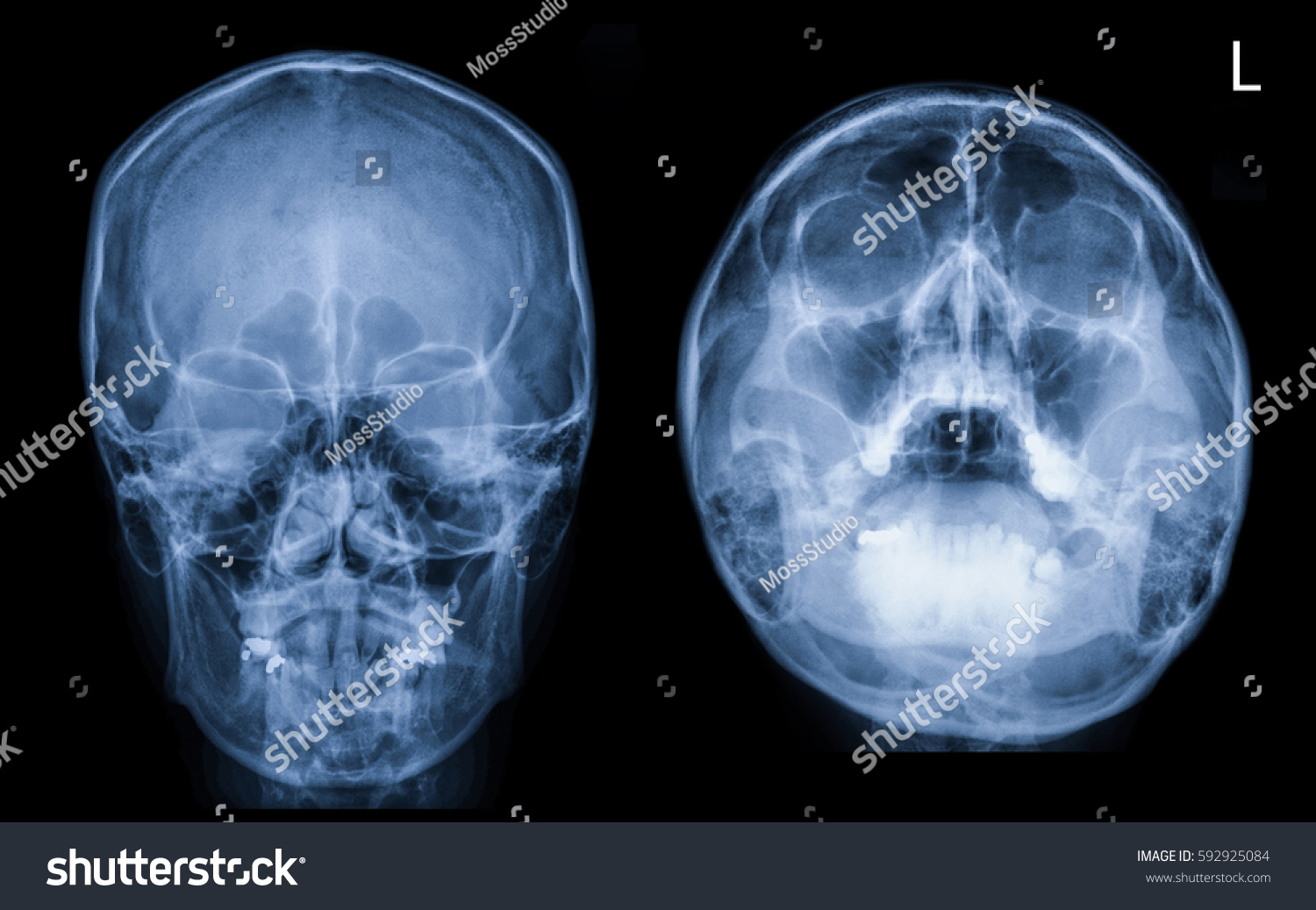 Film Xray Skull Paranasal Sinuses Pns Stock Photo Edit Now 592925084