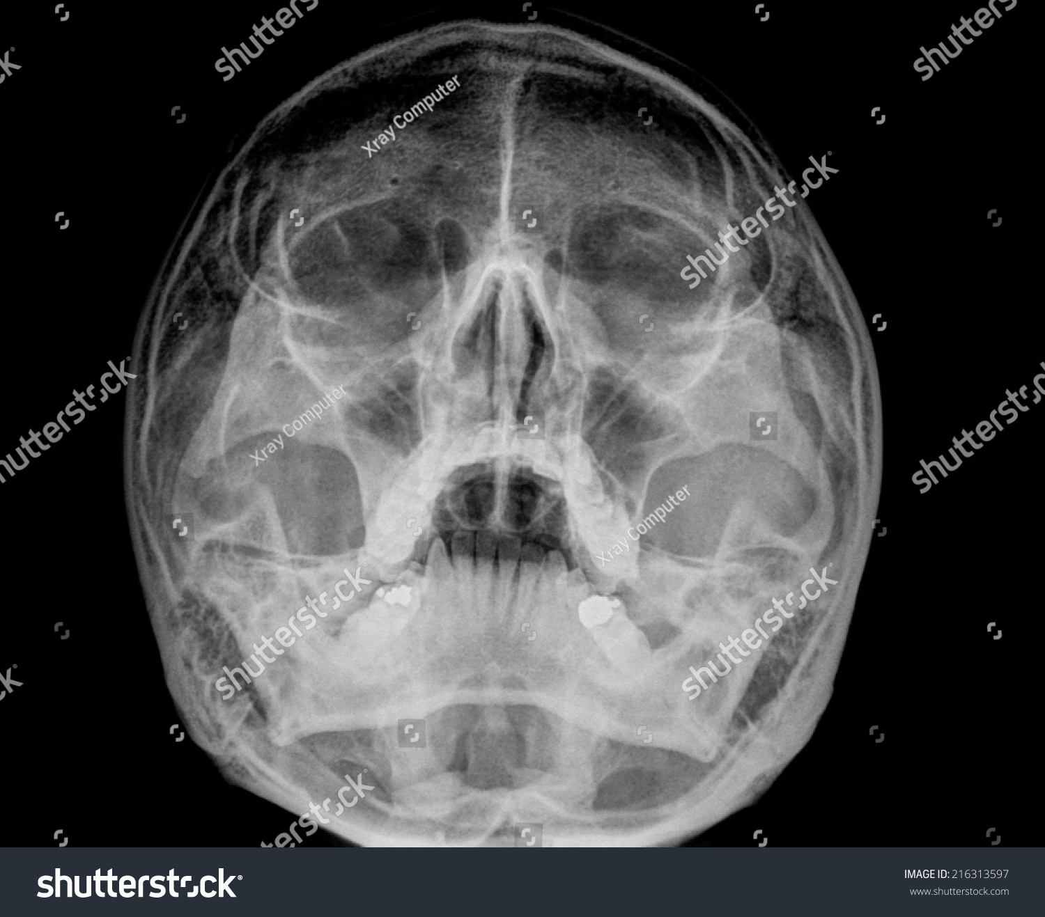 Nasal Bone X Ray
