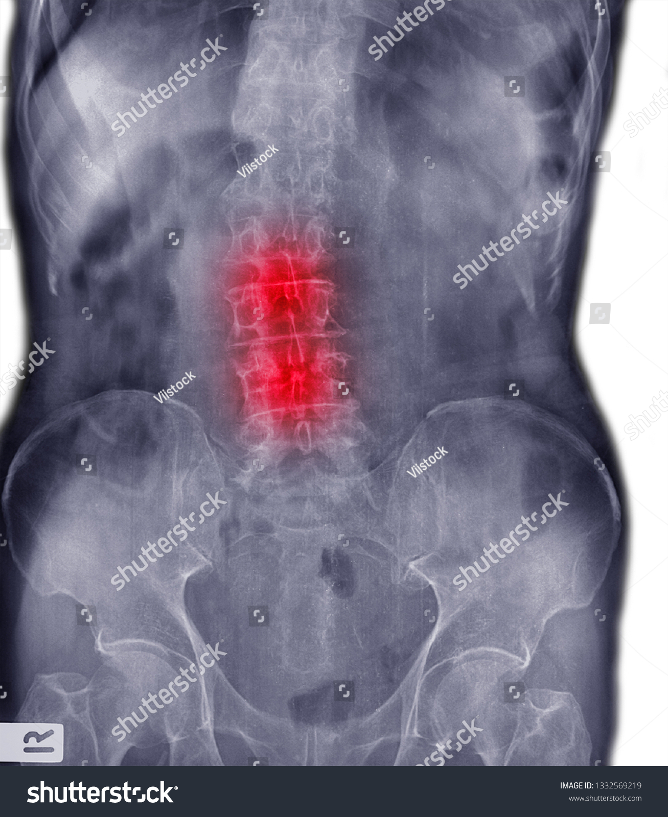 Film Xray Lumbar Spine Adult Patient Stock Illustration 1332569219