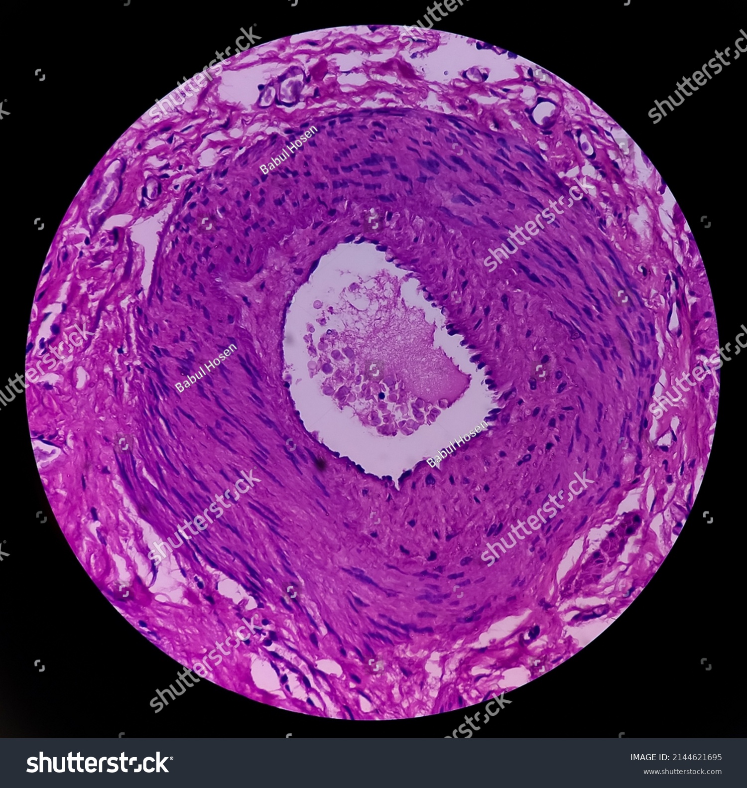 Fimbrial Cystbiopsy Show Fallopian Tube Features Stock Photo 2144621695 ...