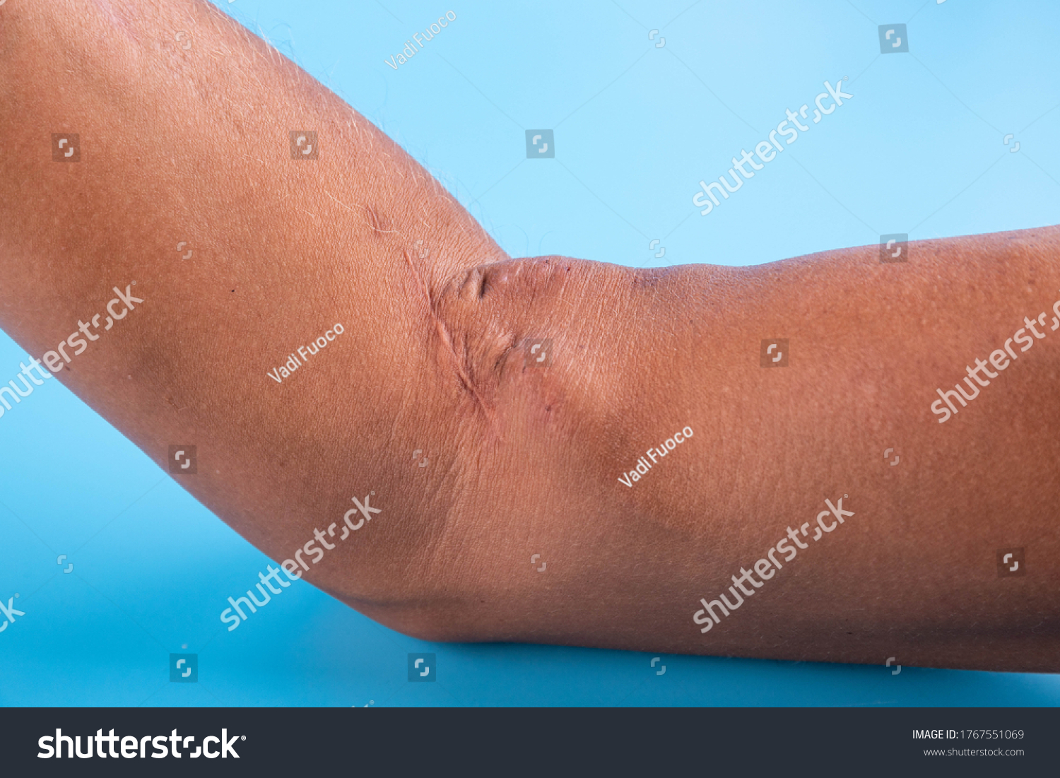 Fistula On Arm Result Operation Hemodialysis Stock Photo (Edit Now