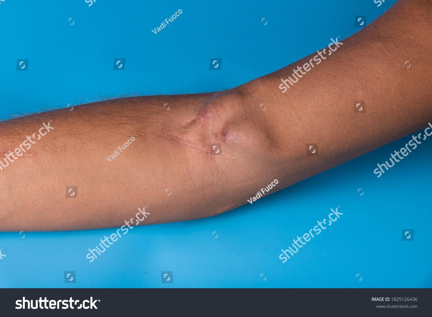 Fistula On Arm Result Operation Hemodialysis Stock Photo (Edit Now