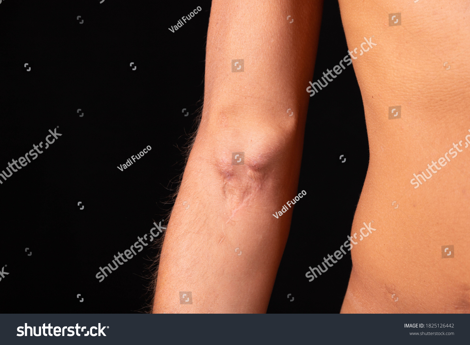 Fistula On Arm Result Operation Hemodialysis Stock Photo (Edit Now