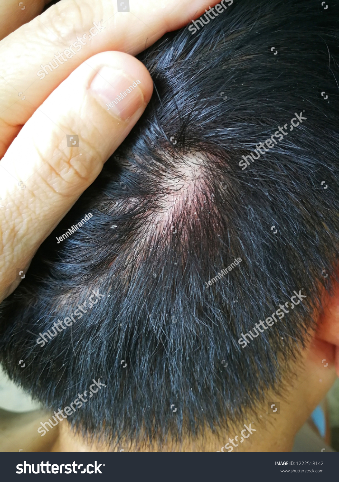 Flakes Itchy Scaly Scalp Main Symptoms Stock Photo Edit Now 1222518142