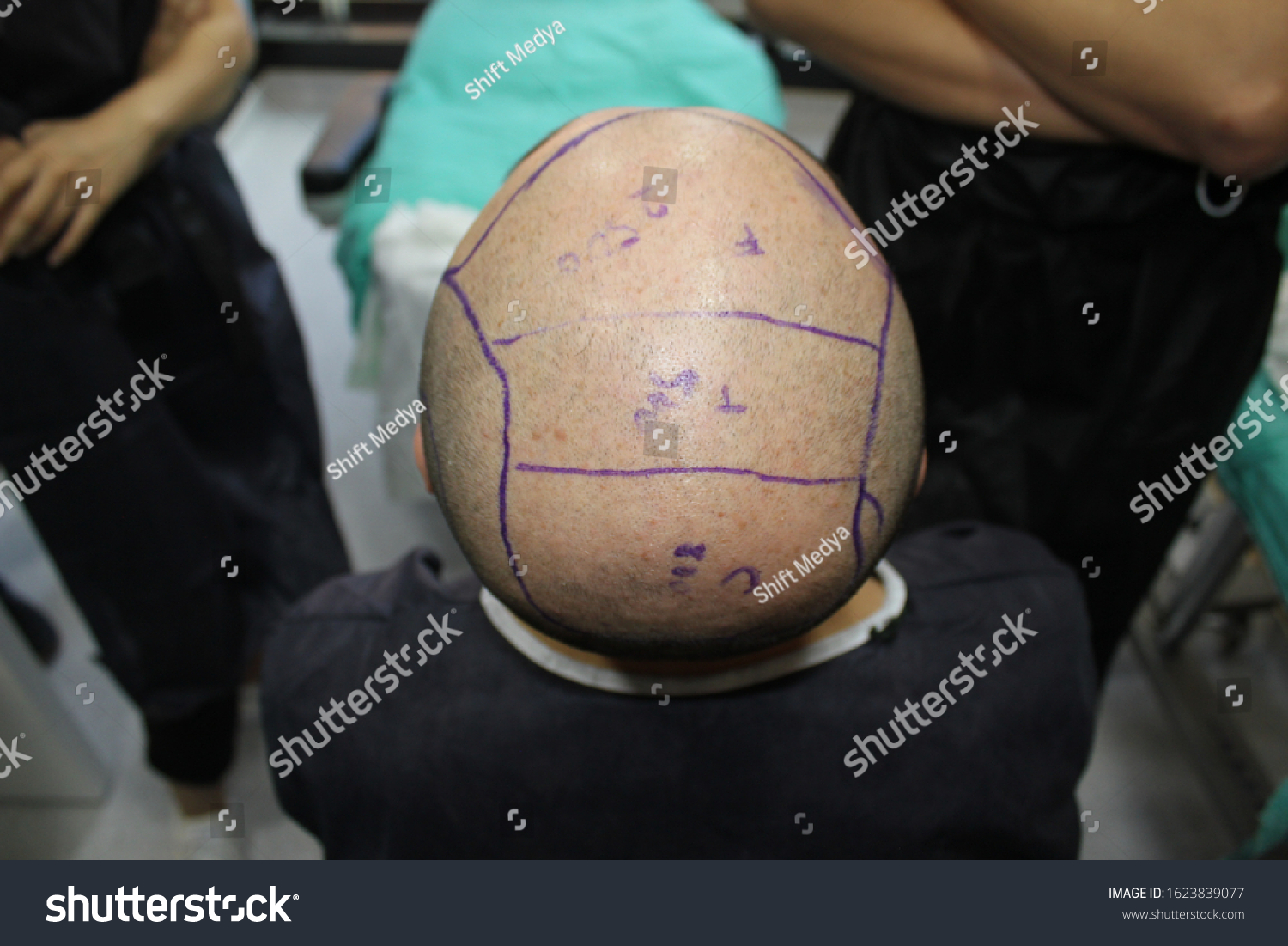 Follicular Unit Extraction Fue Hair Transplant Stock Photo 1623839077 ...